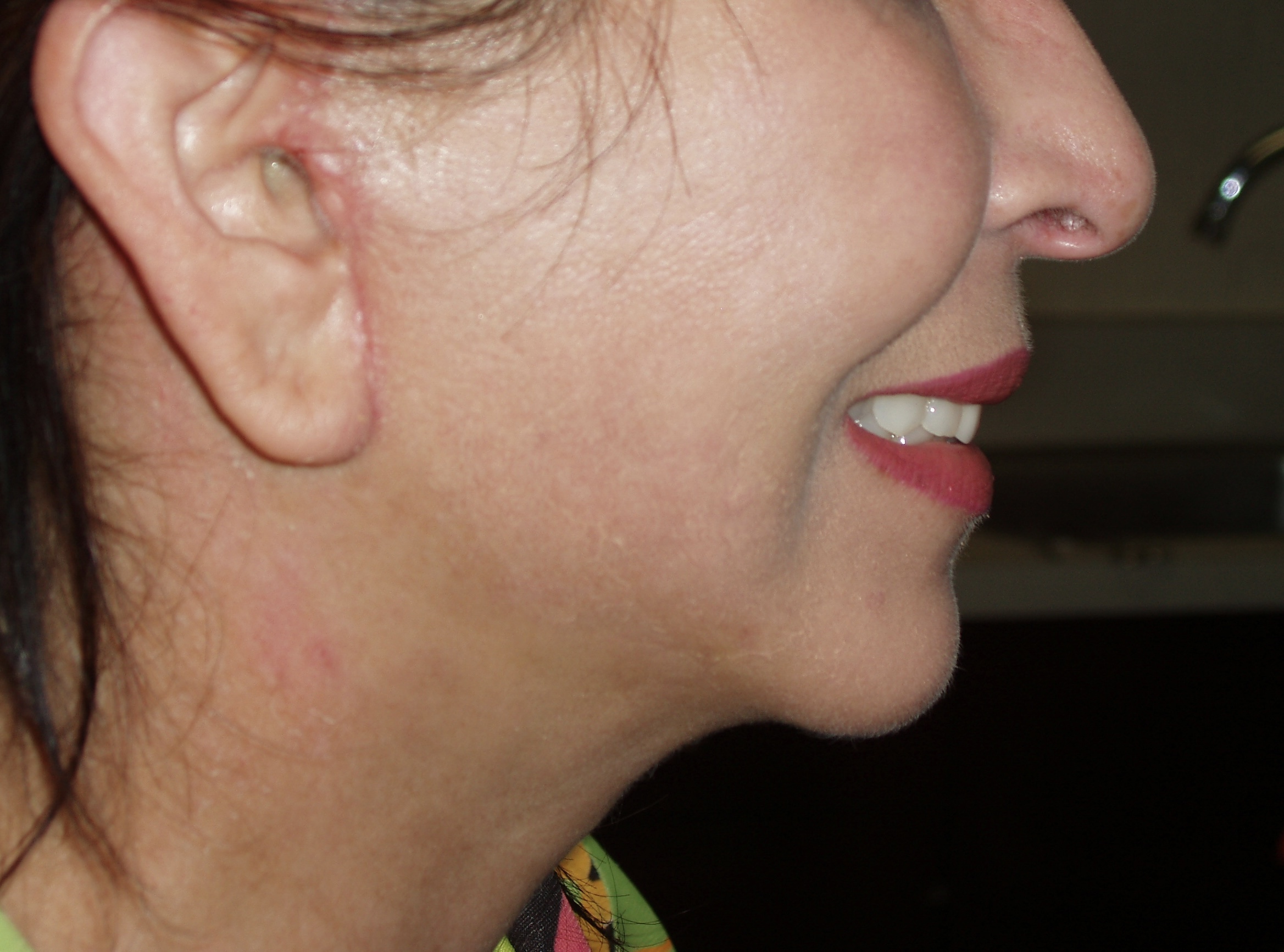 After face and neck lift, patient 17
