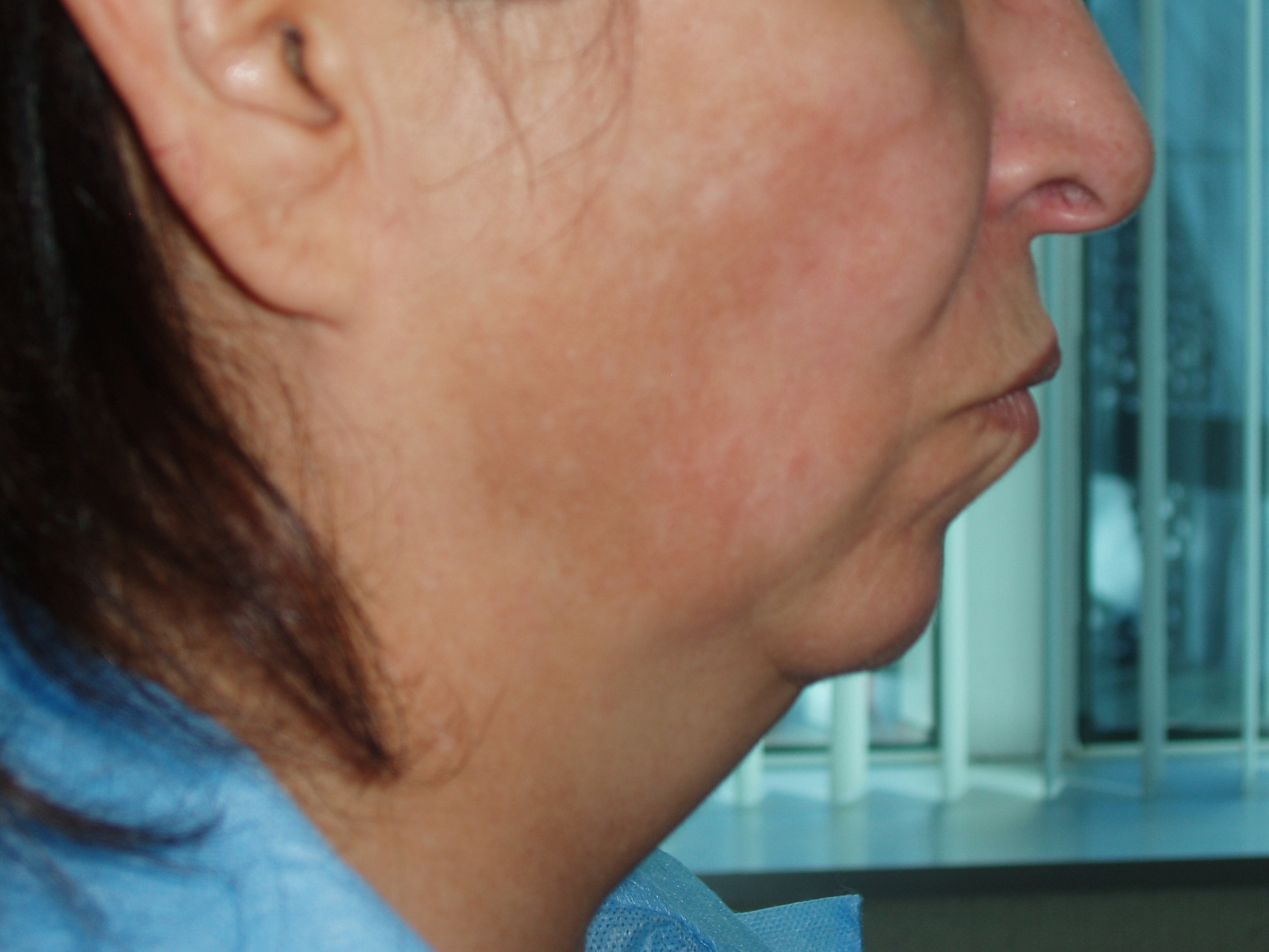 Before face and neck lift, patient 17