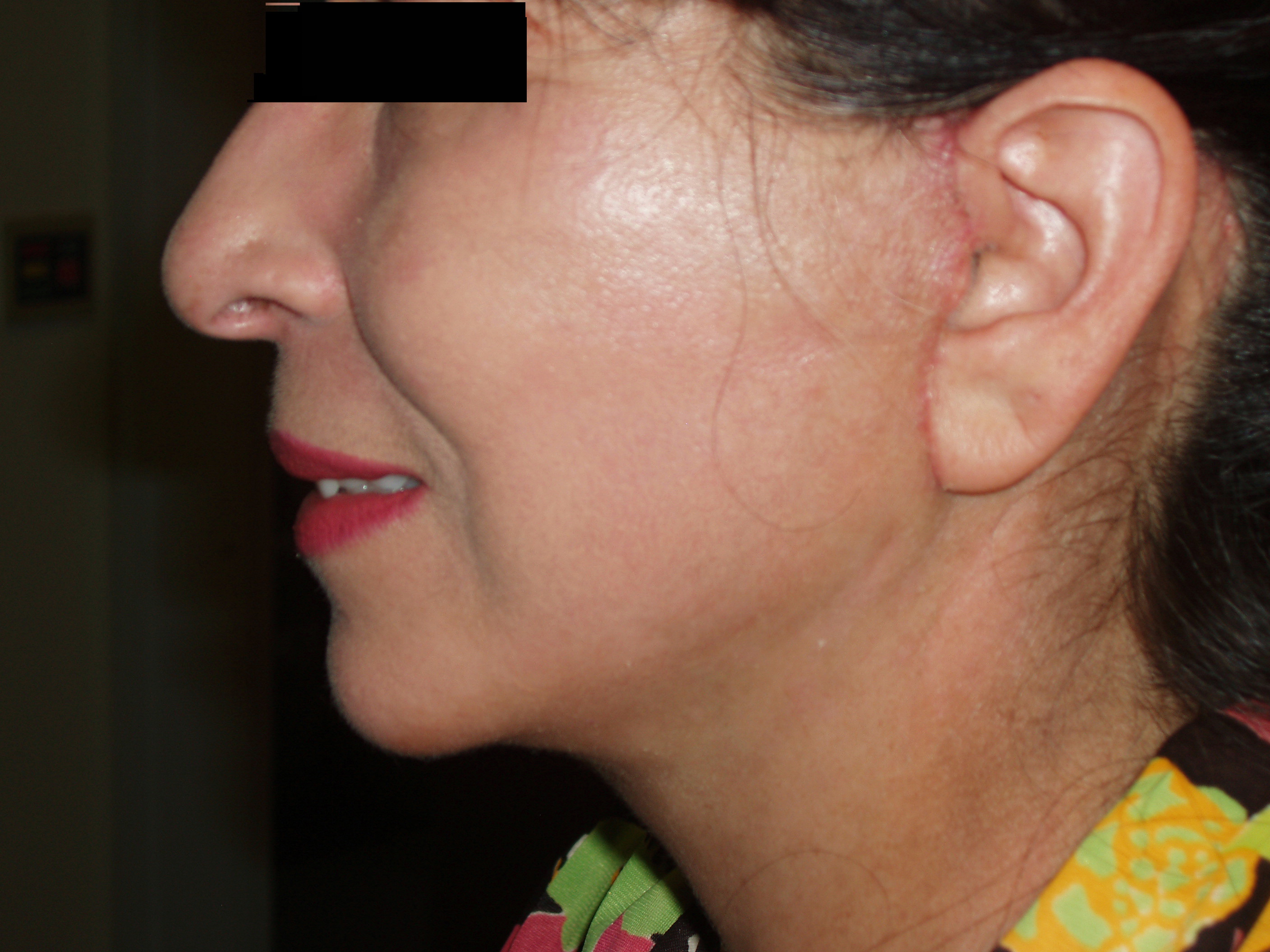 After face and neck lift, patient 18
