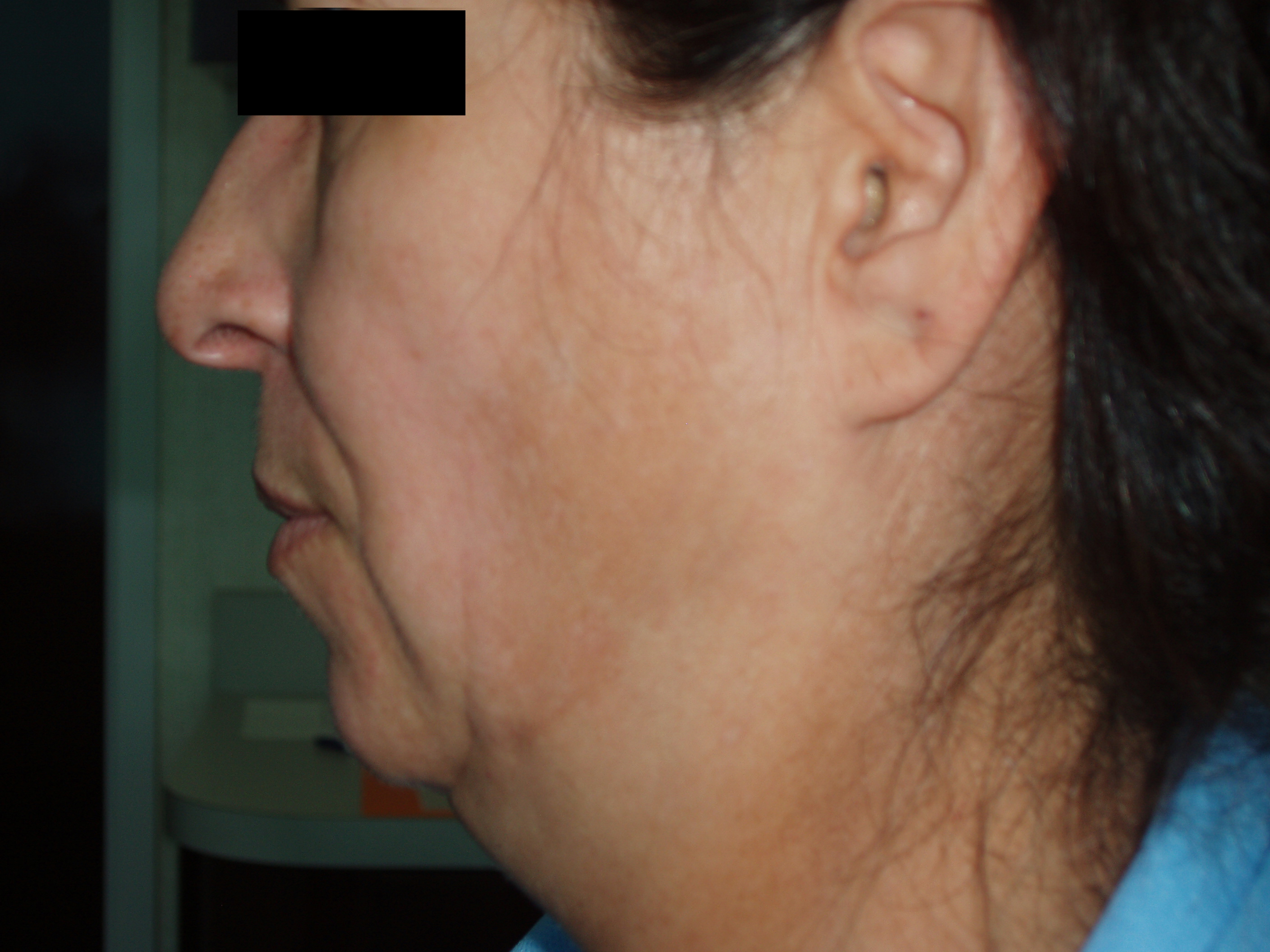 Before face and neck lift, patient 18