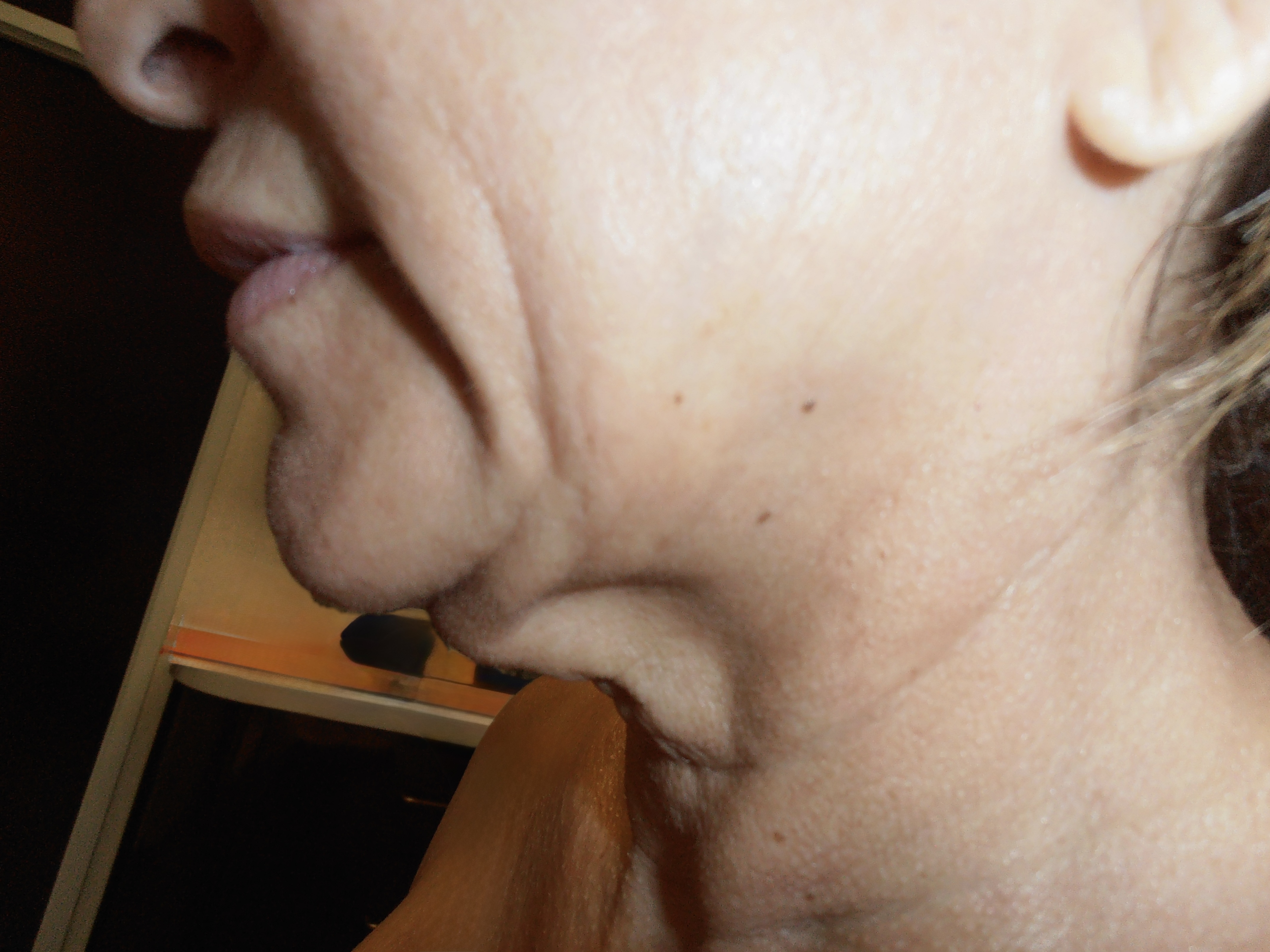 Before face and neck lift, patient 6