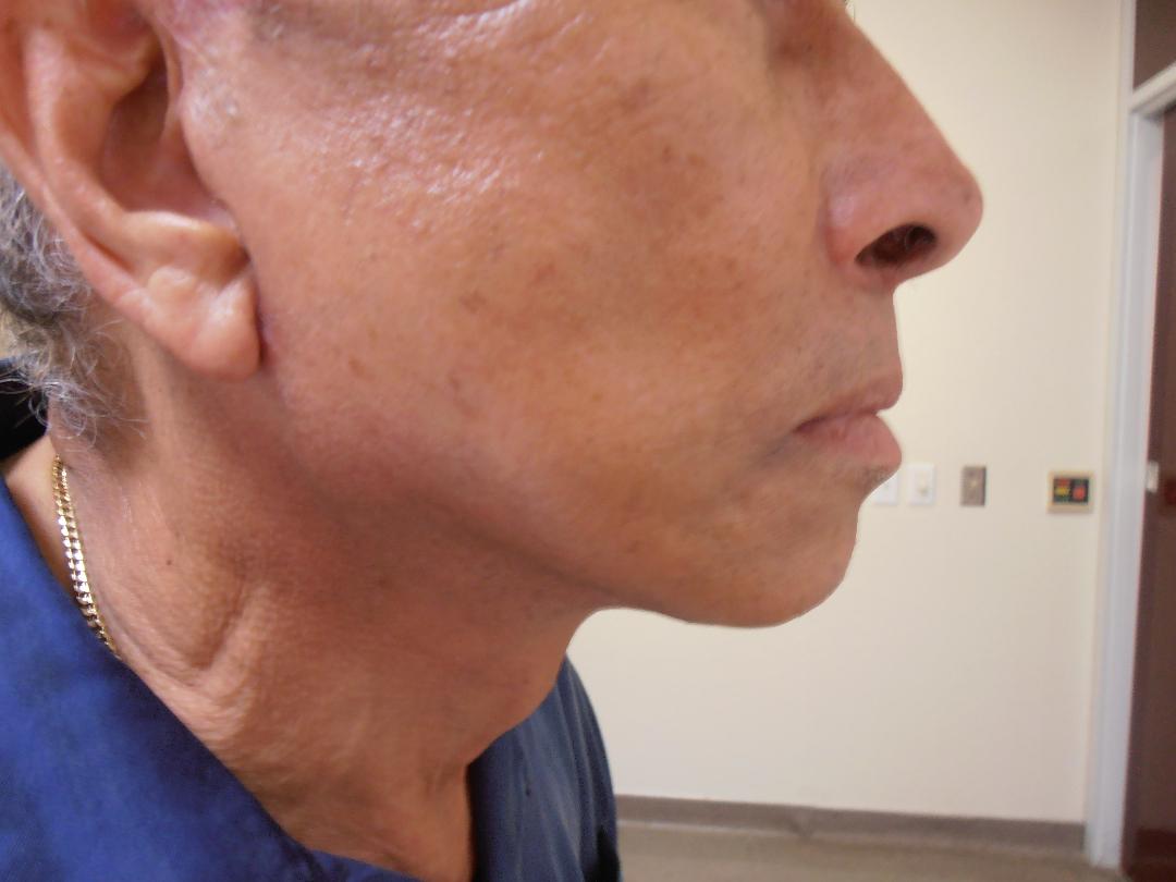 After neck lift, patient 9