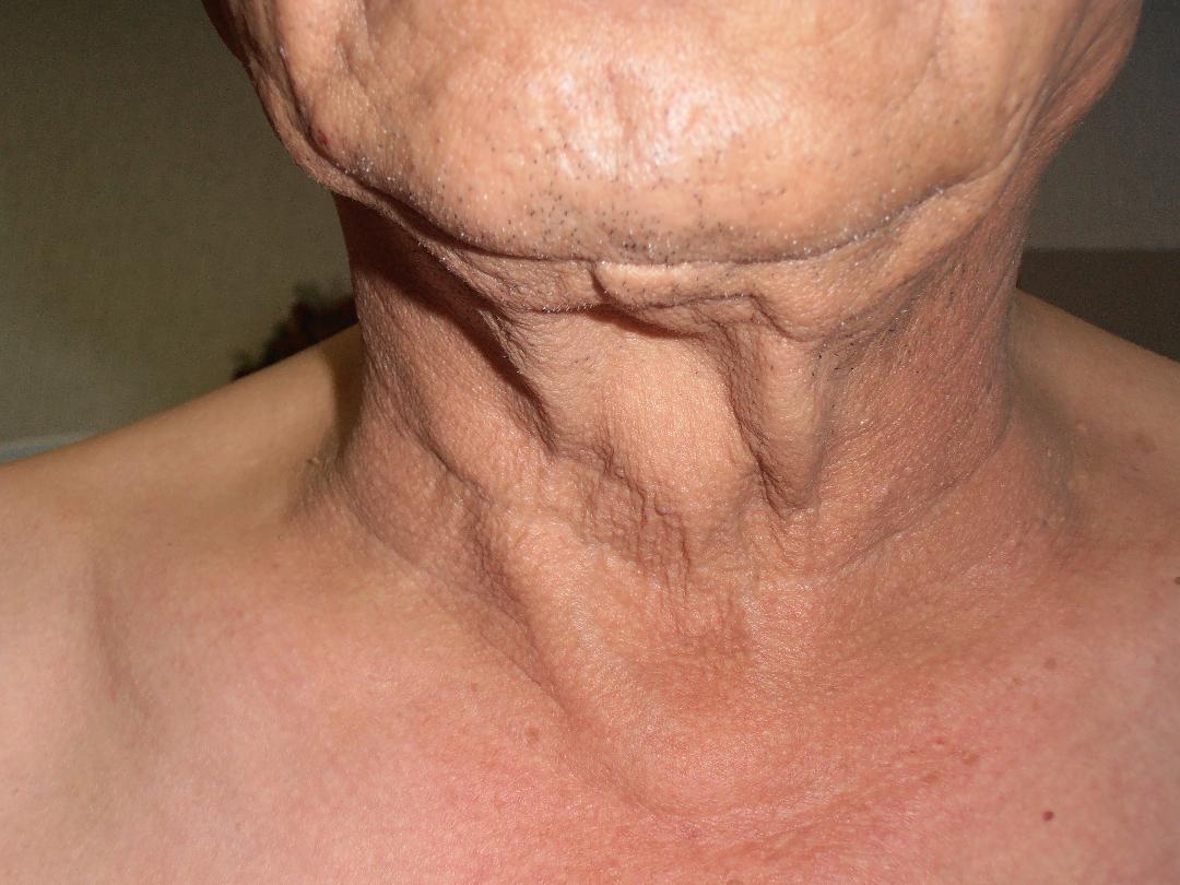 Before neck lift, patient 8