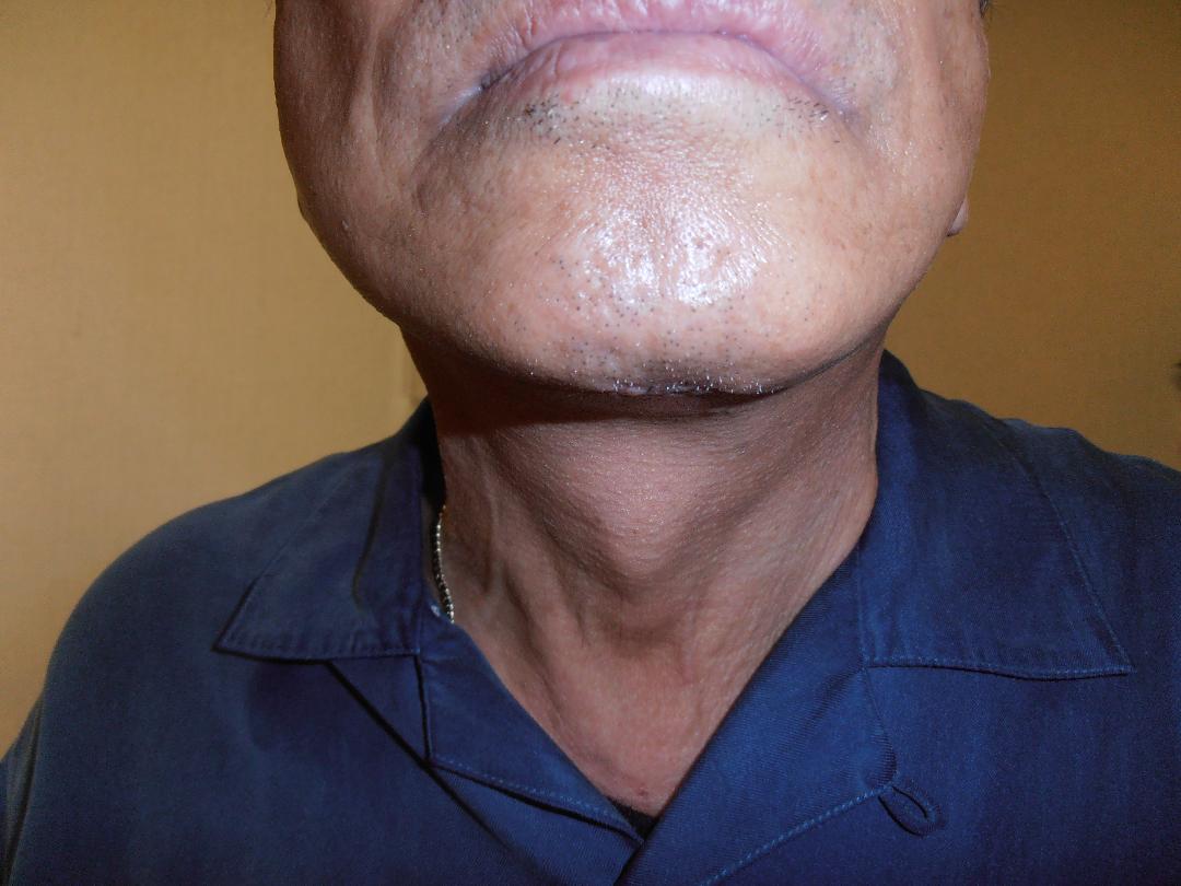After neck lift, patient 8