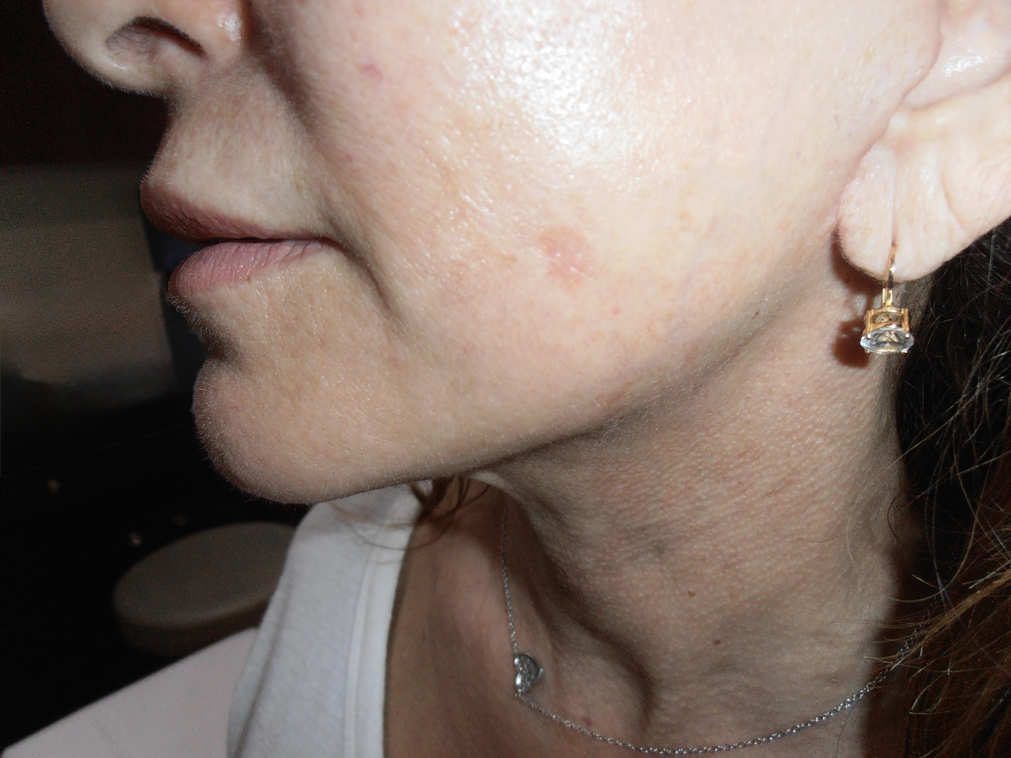 After face and neck lift, patient 6