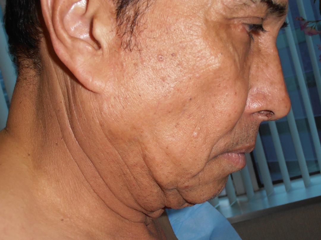 Before neck lift, patient 9