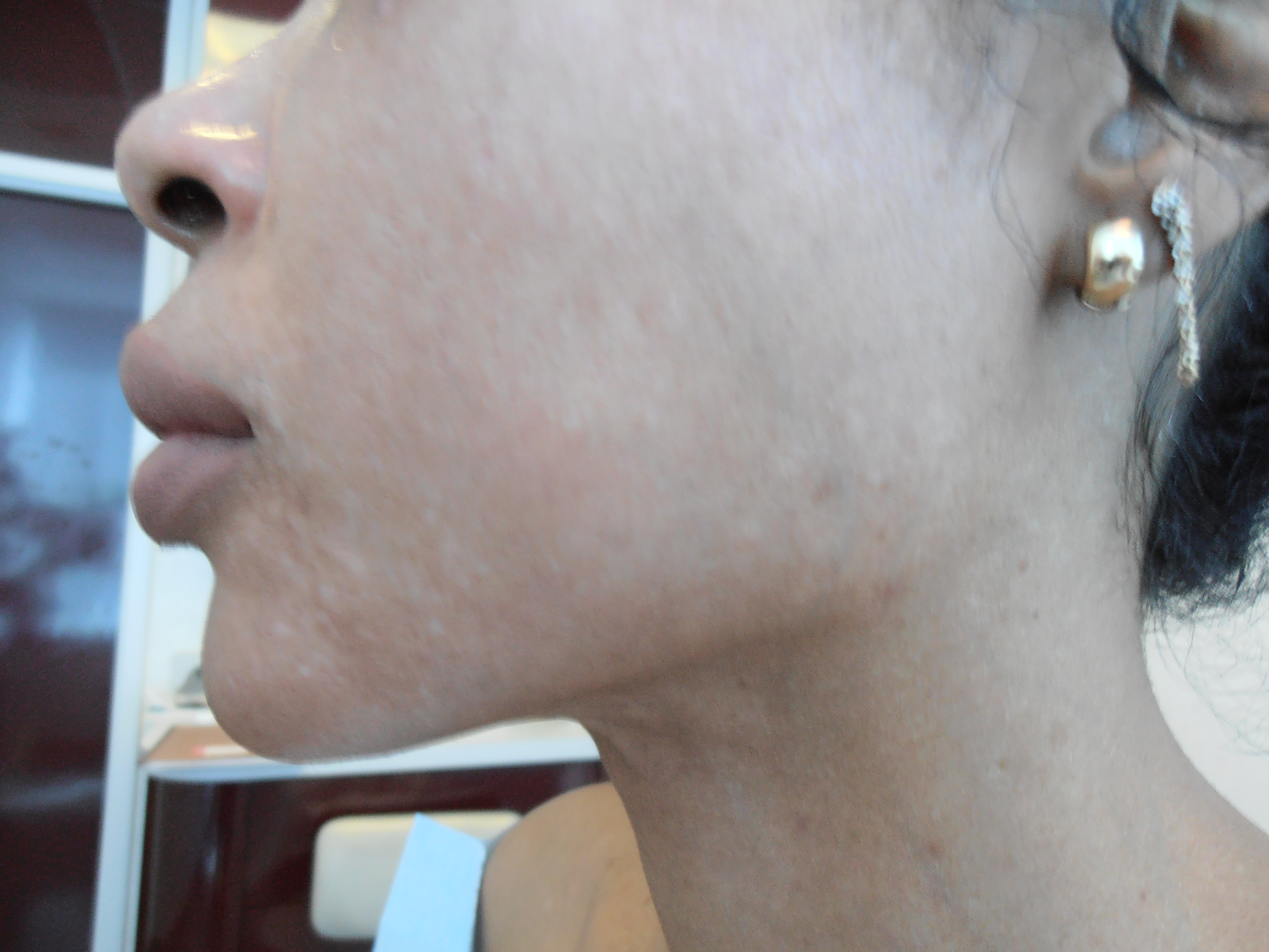 After face and neck lift, patient 7