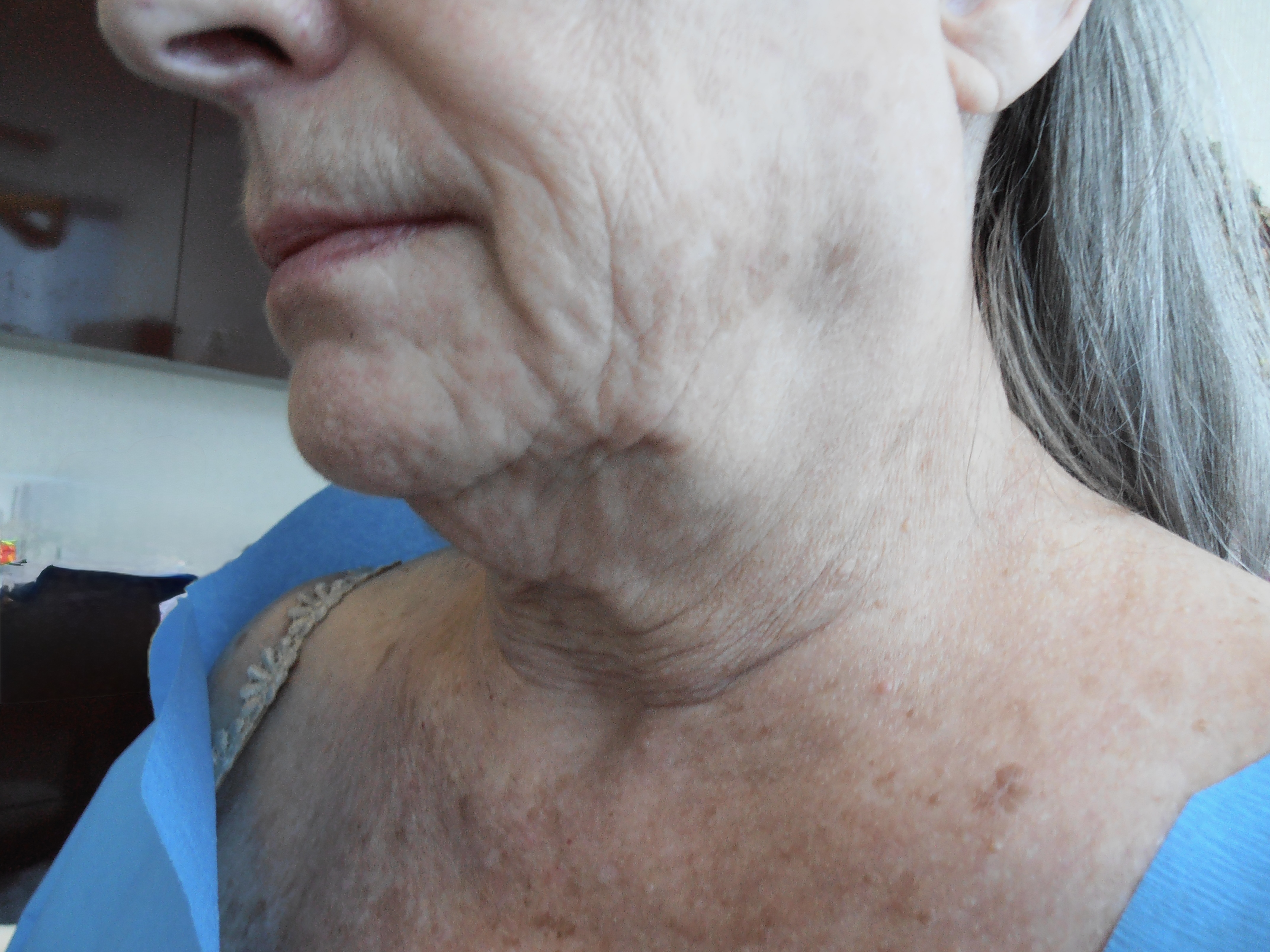 Before face and neck lift, patient 15