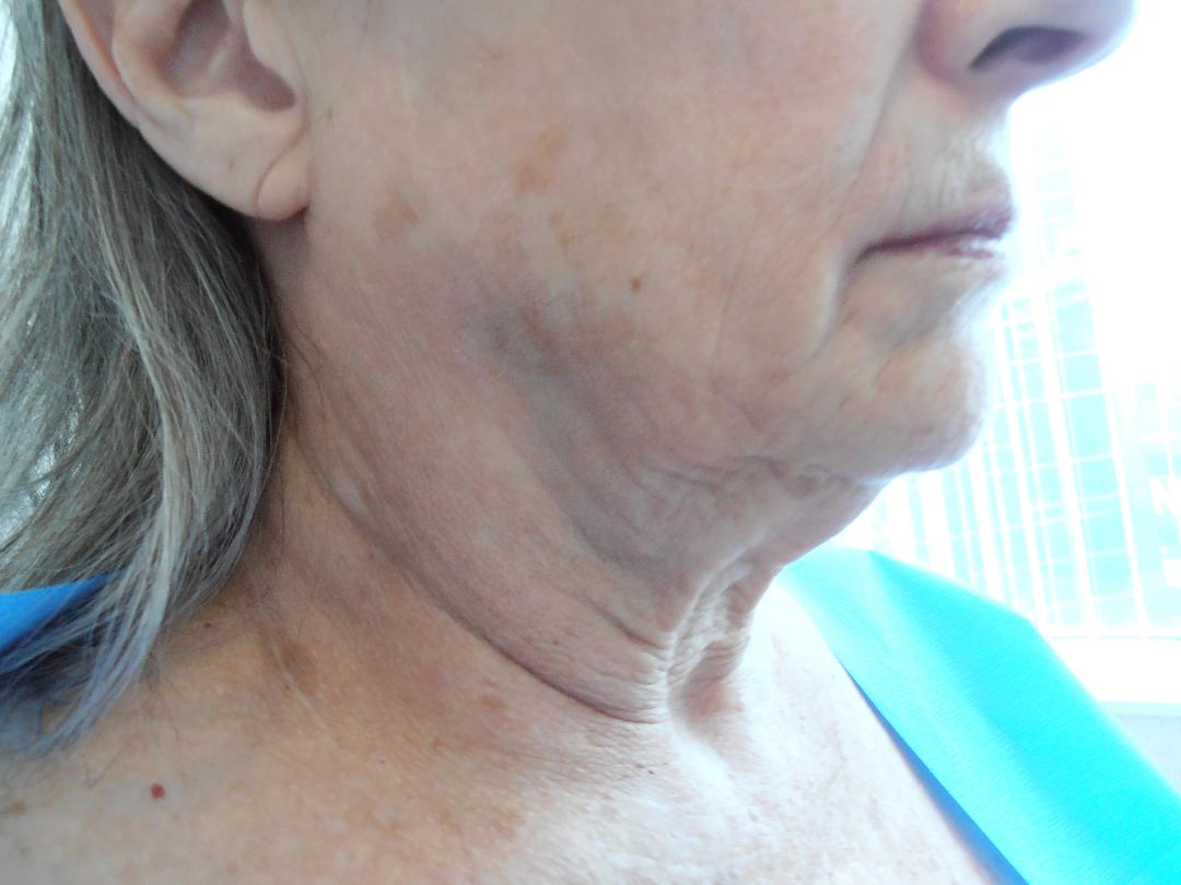 Before face and neck lift, patient 16