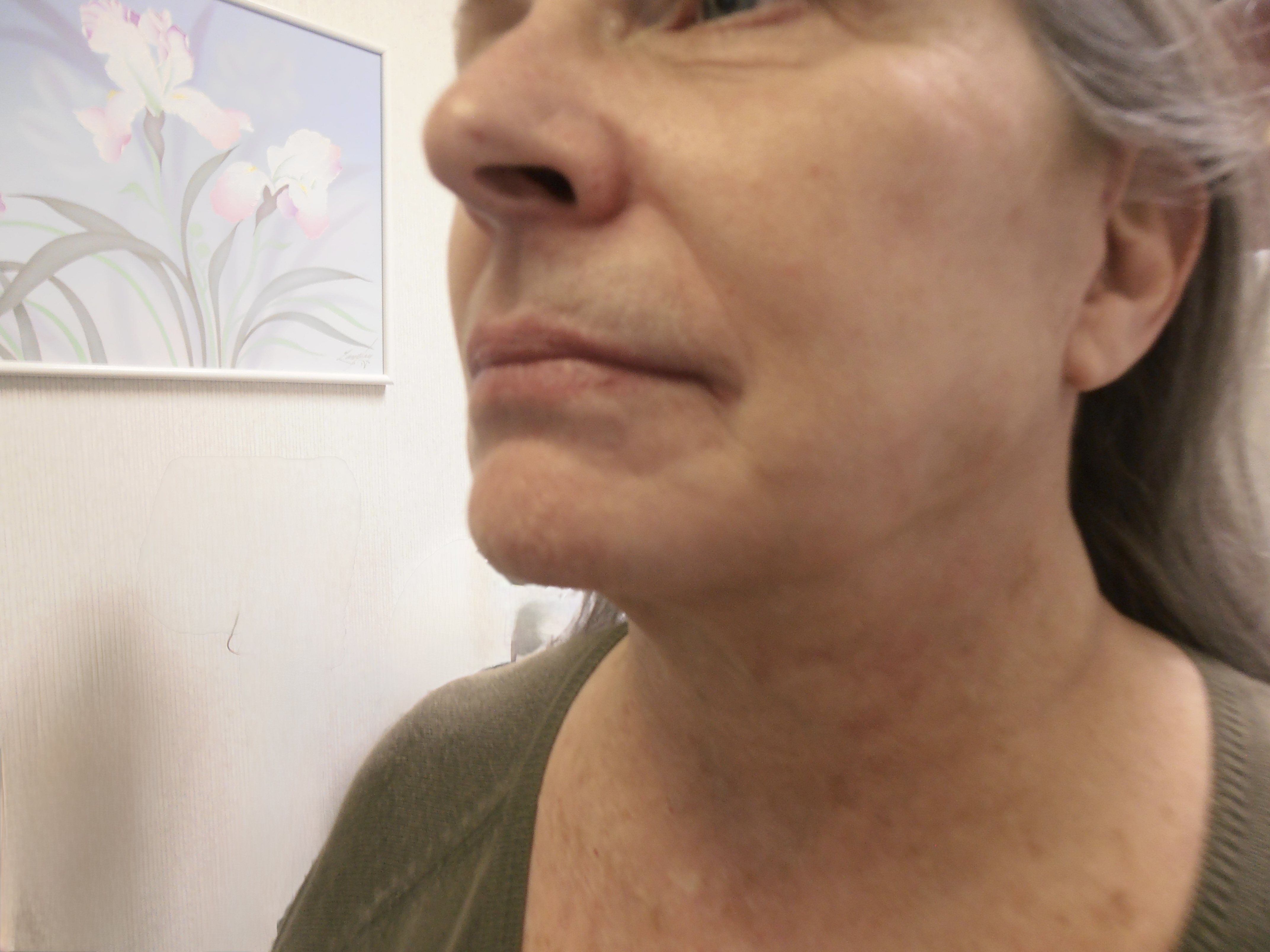 After face and neck lift, patient 15
