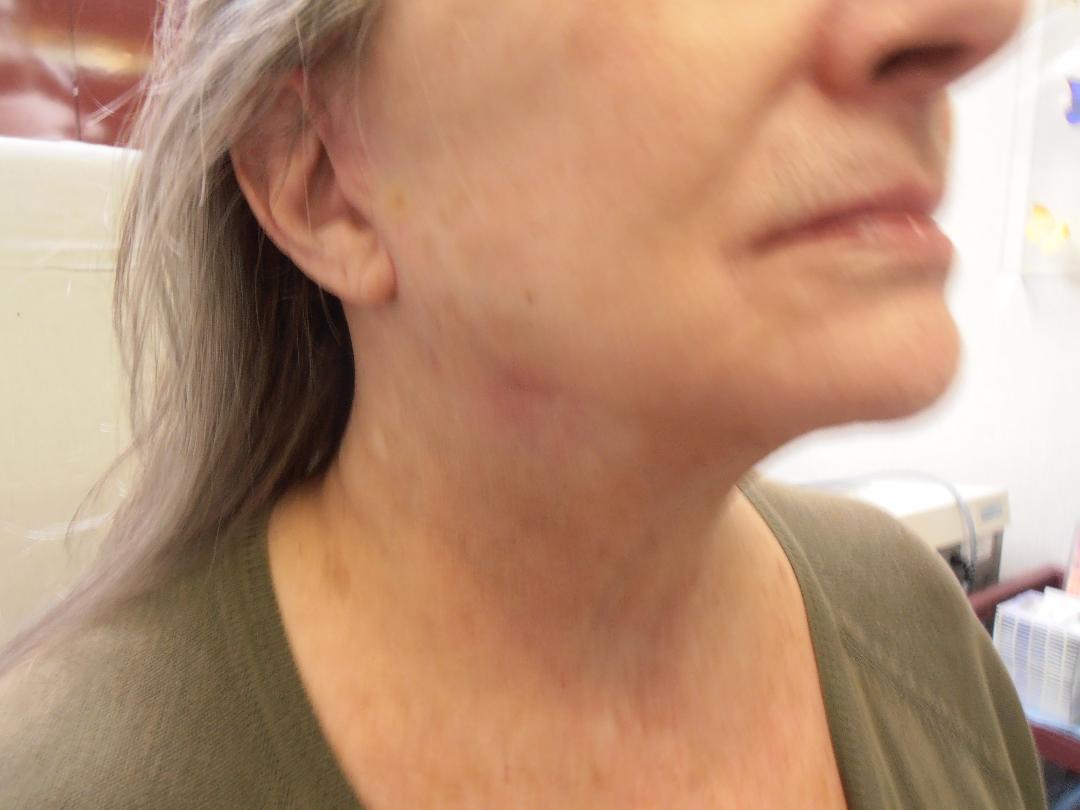 After face and neck lift, patient 16