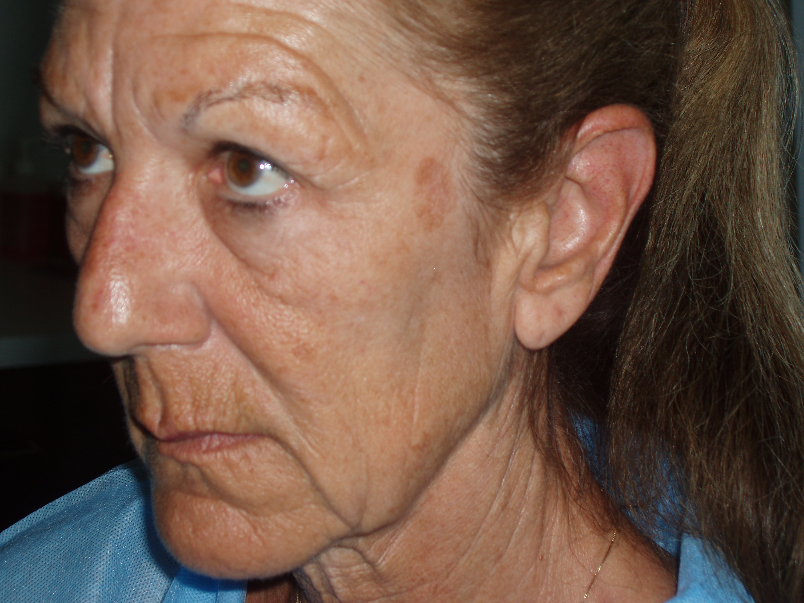 Before deep plane face and neck lift, patient 2