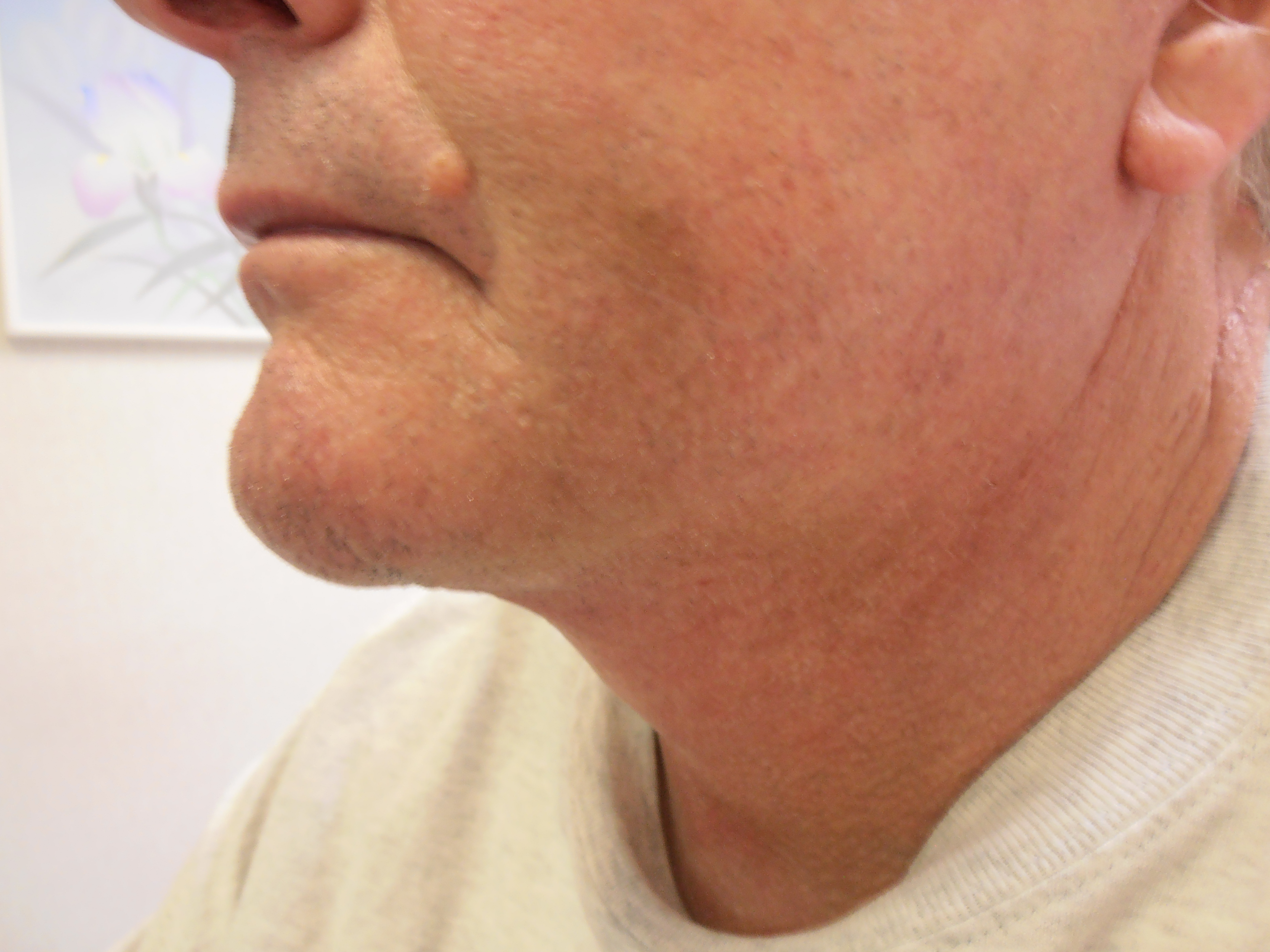 After face and neck lift, patient 14