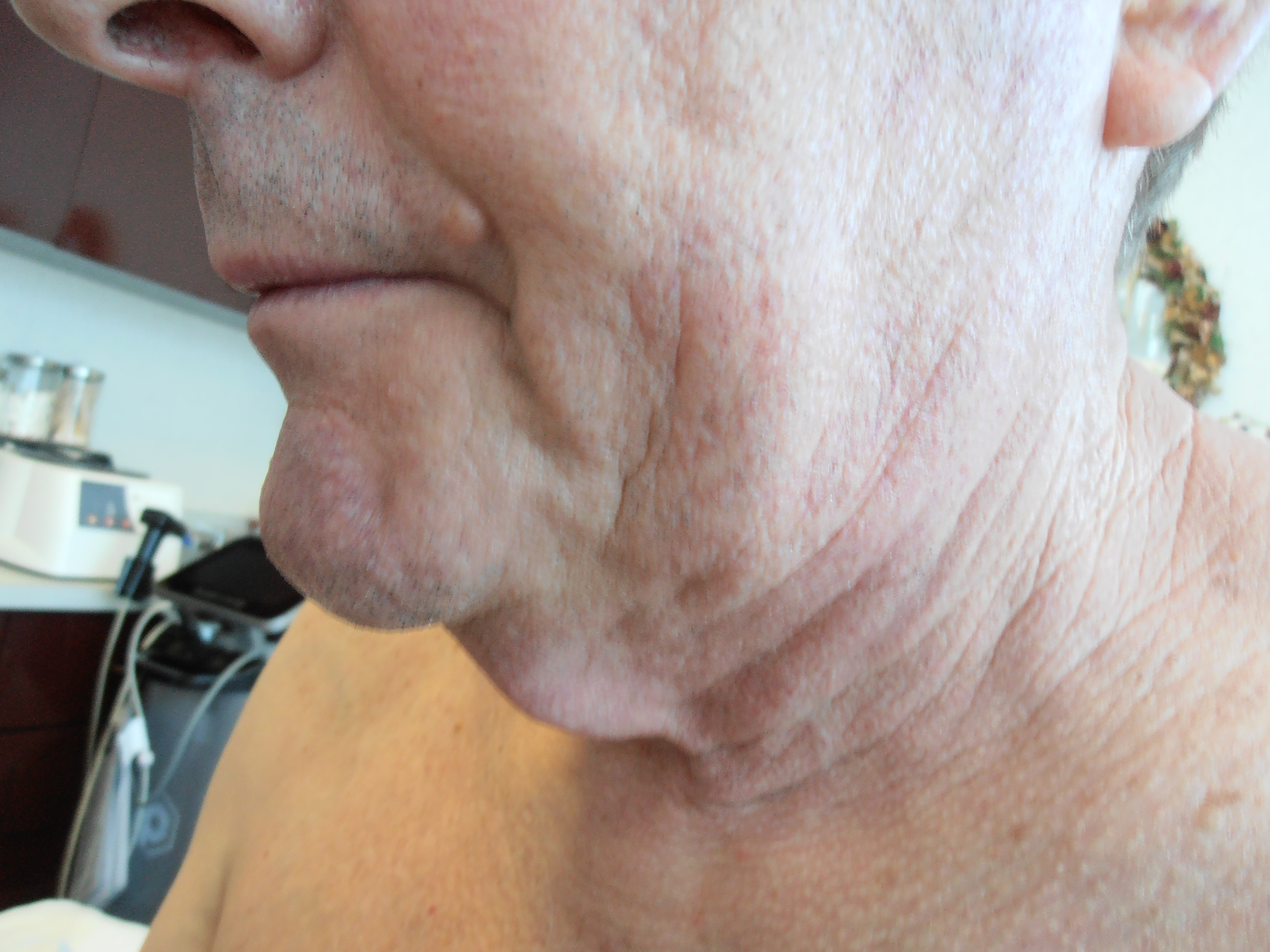 Before face and neck lift, patient 14