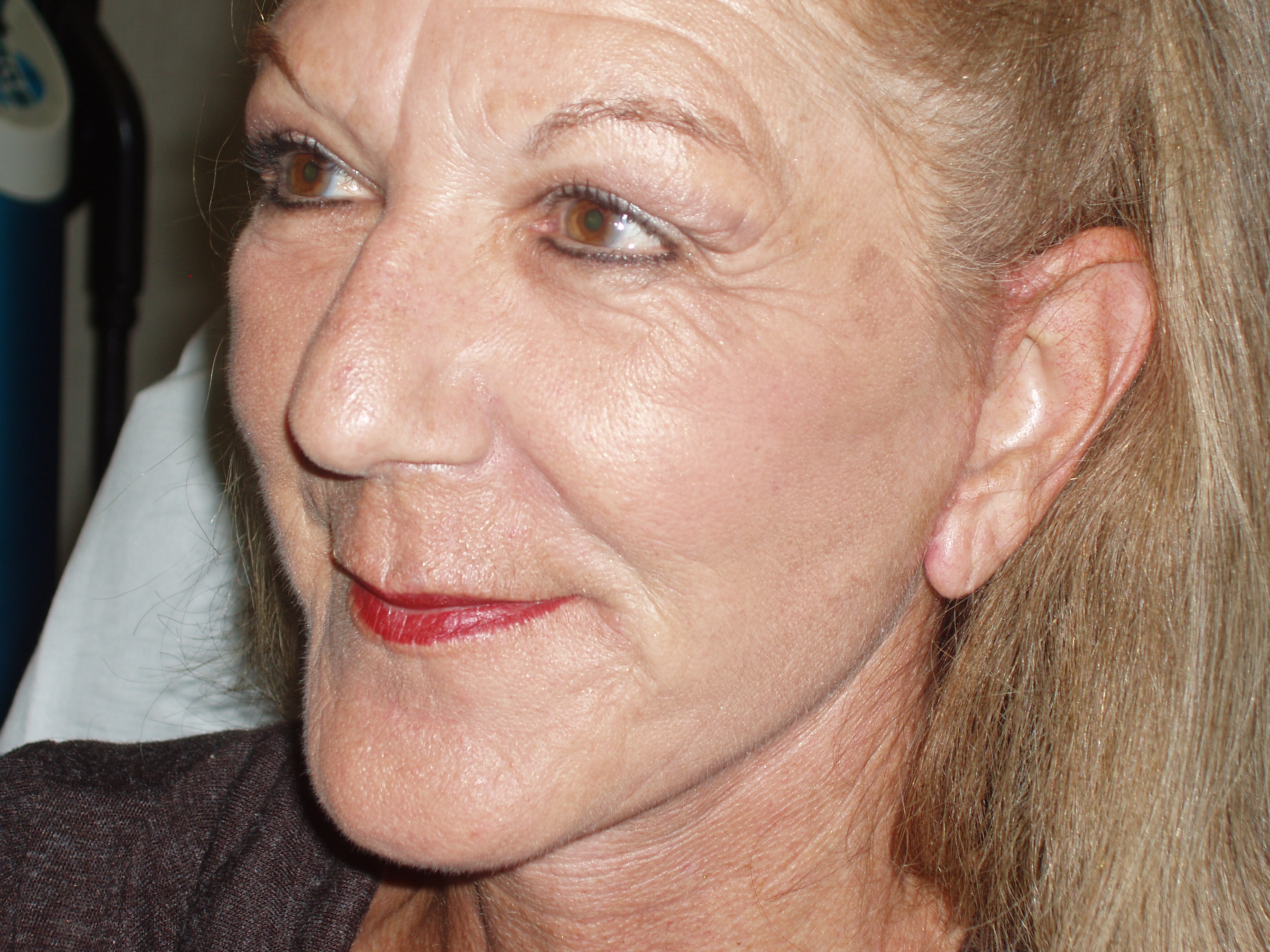 After deep plane face and neck lift, patient 2