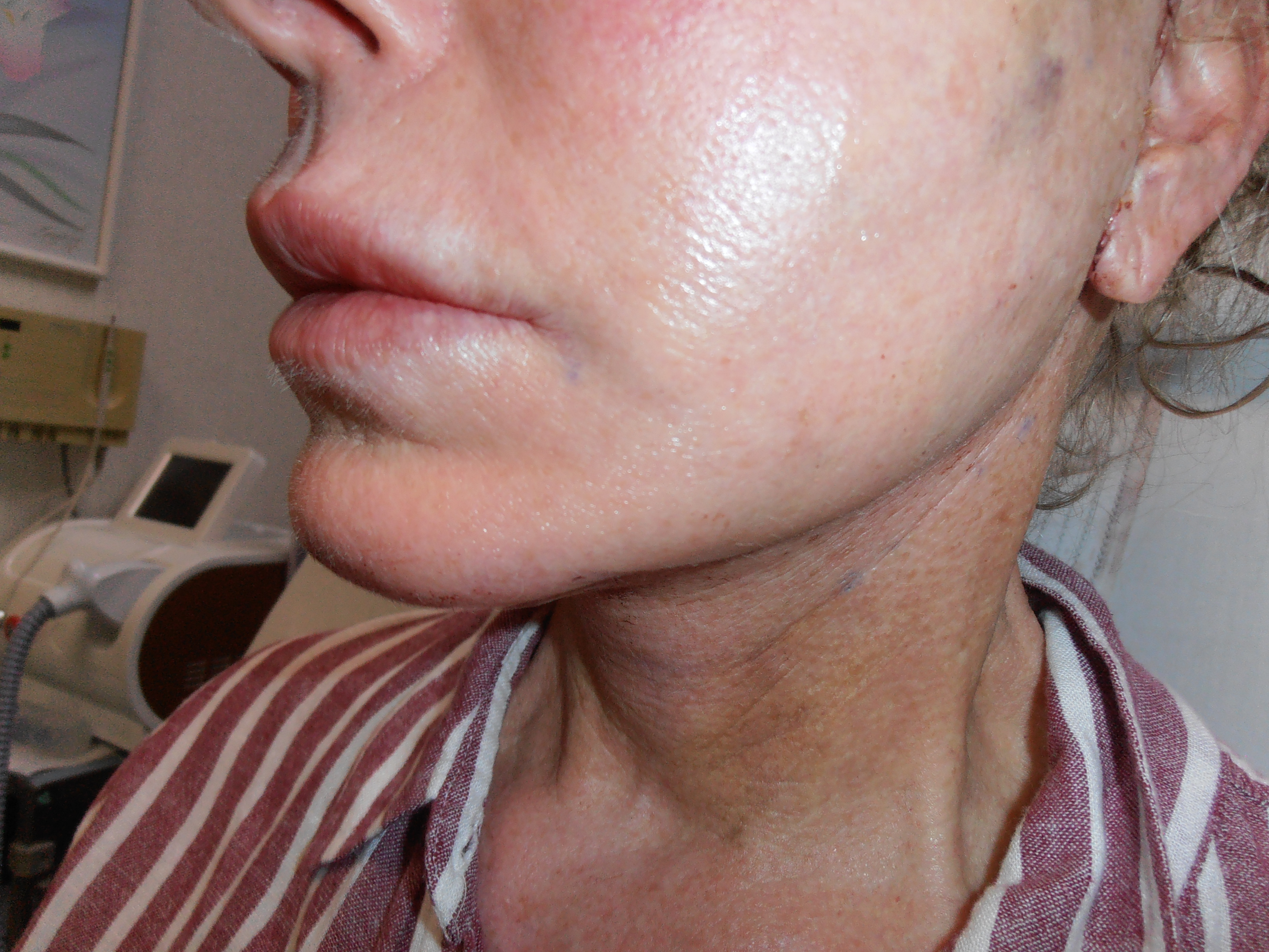 After face and neck lift, patient 13
