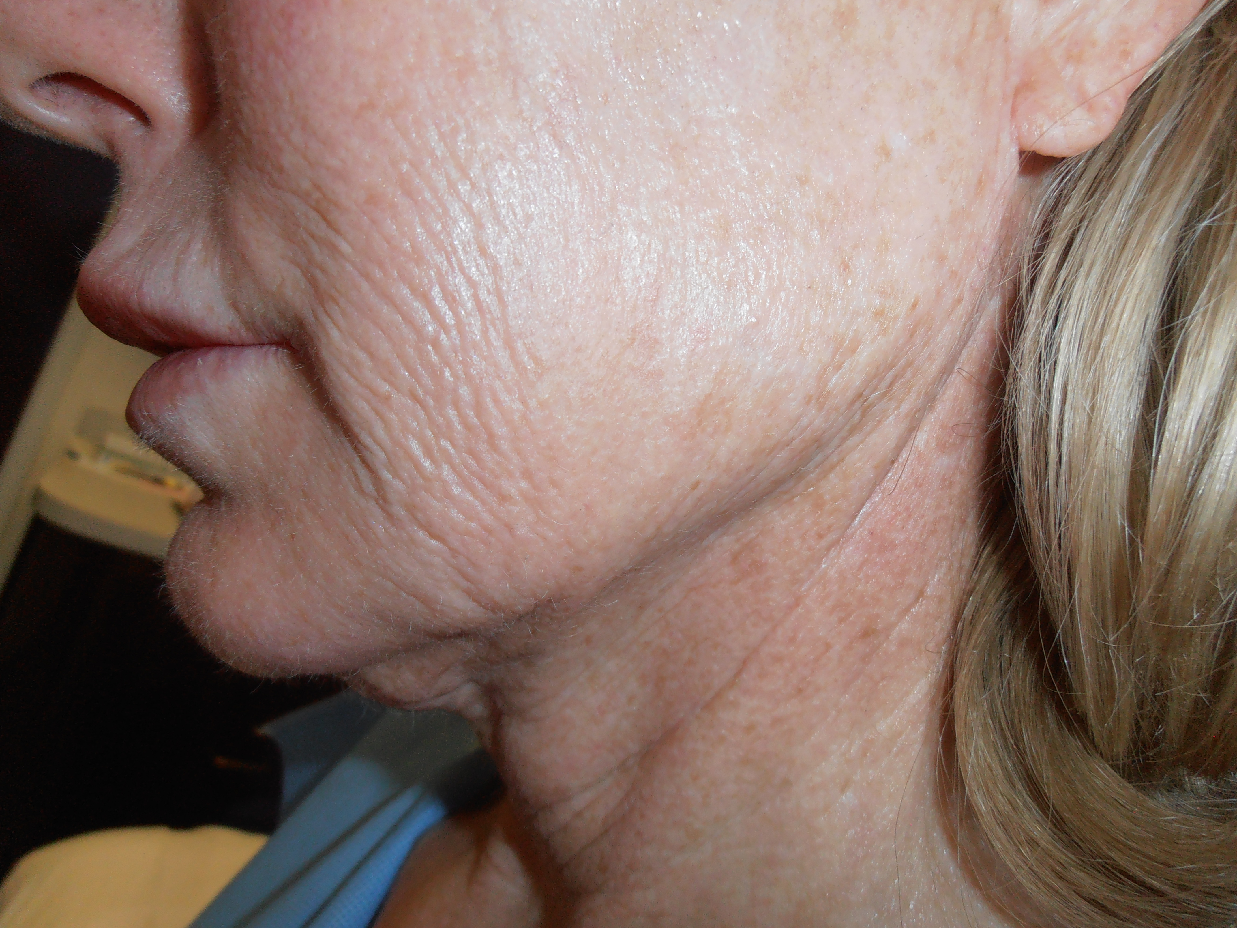 Before face and neck lift, patient 13