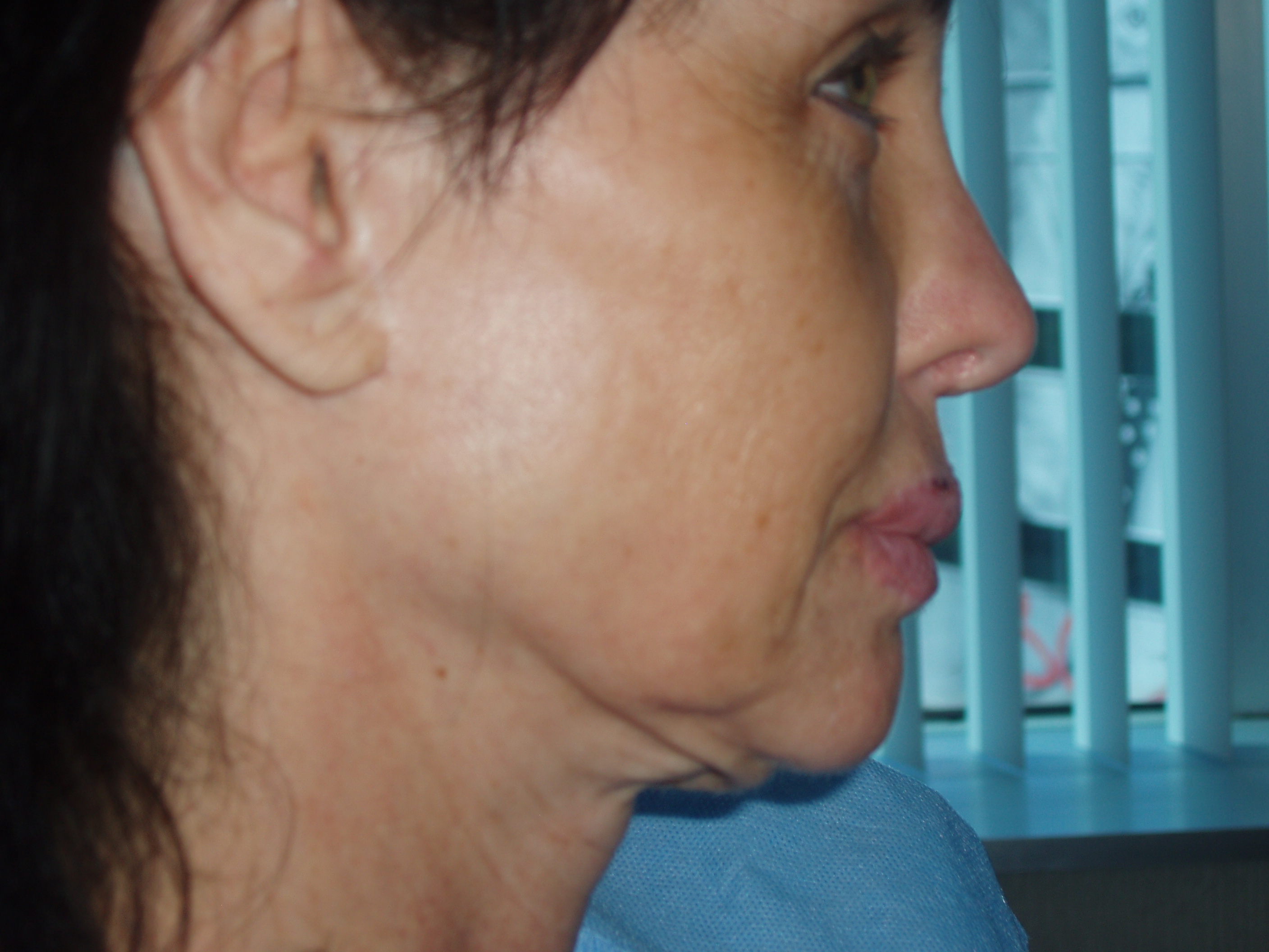 Before face and neck lift, patient 1