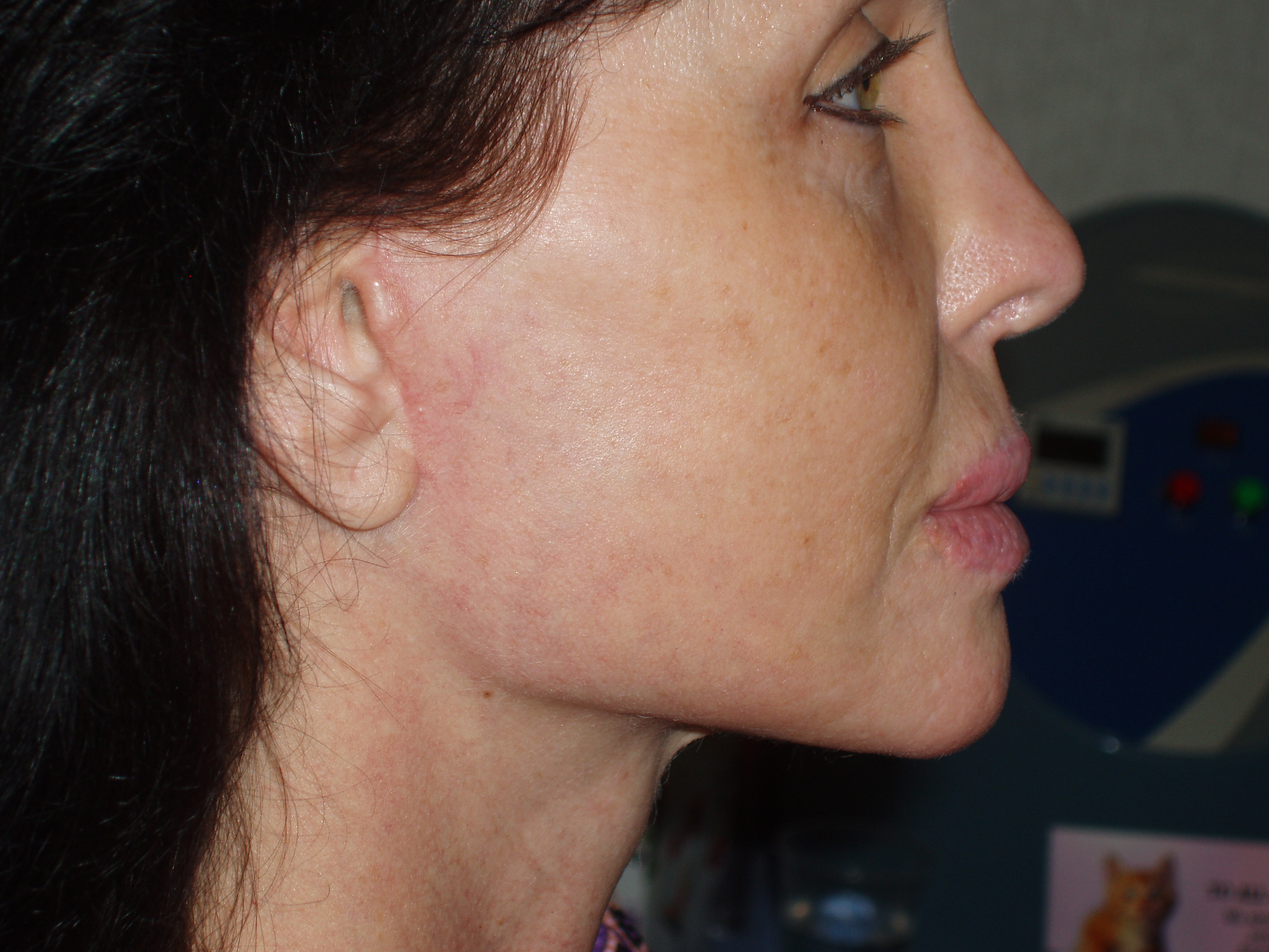 After face and neck lift, patient 1