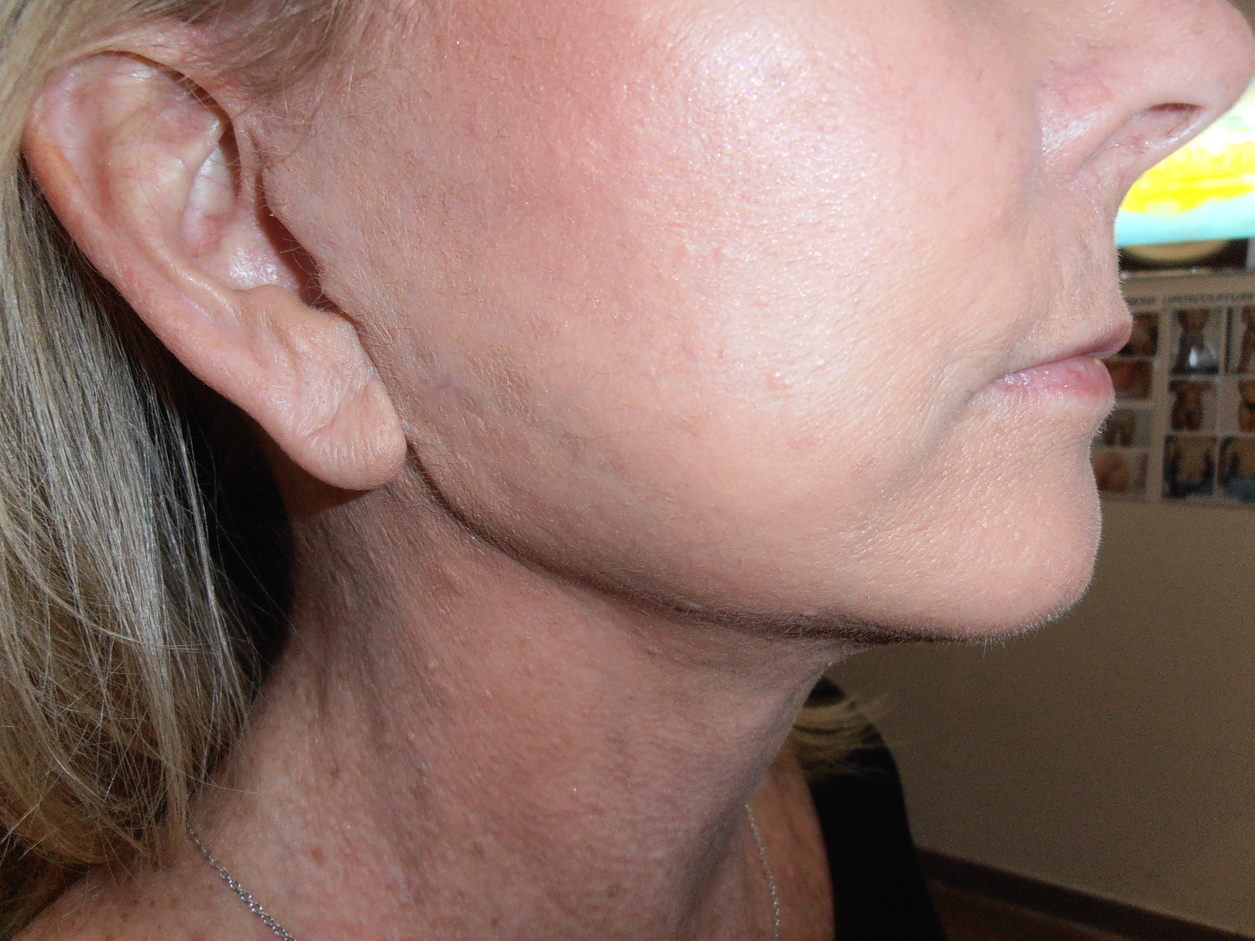 After facelift and earlobe repair, patient 12