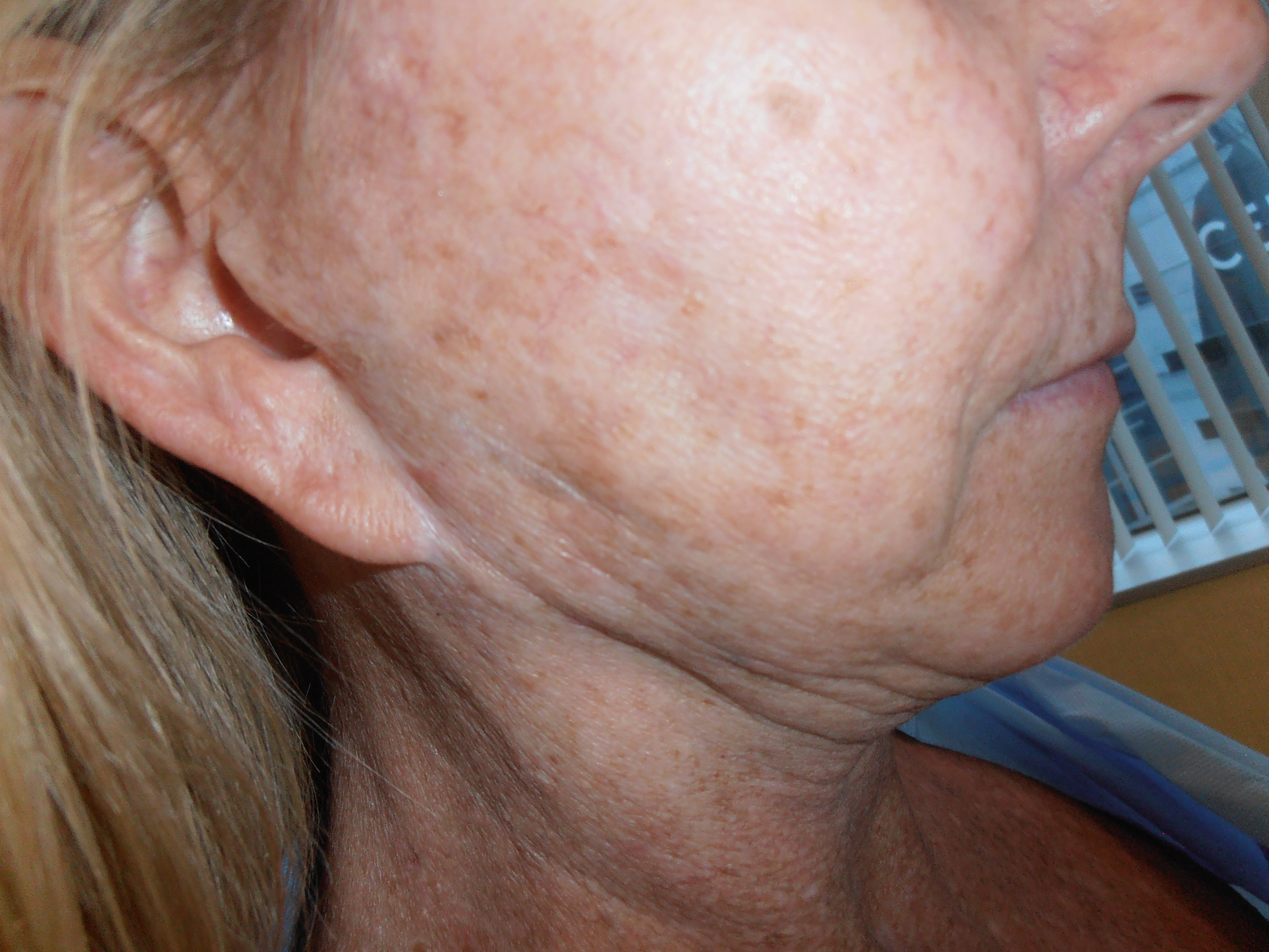 Before facelift and earlobe repair, patient 12
