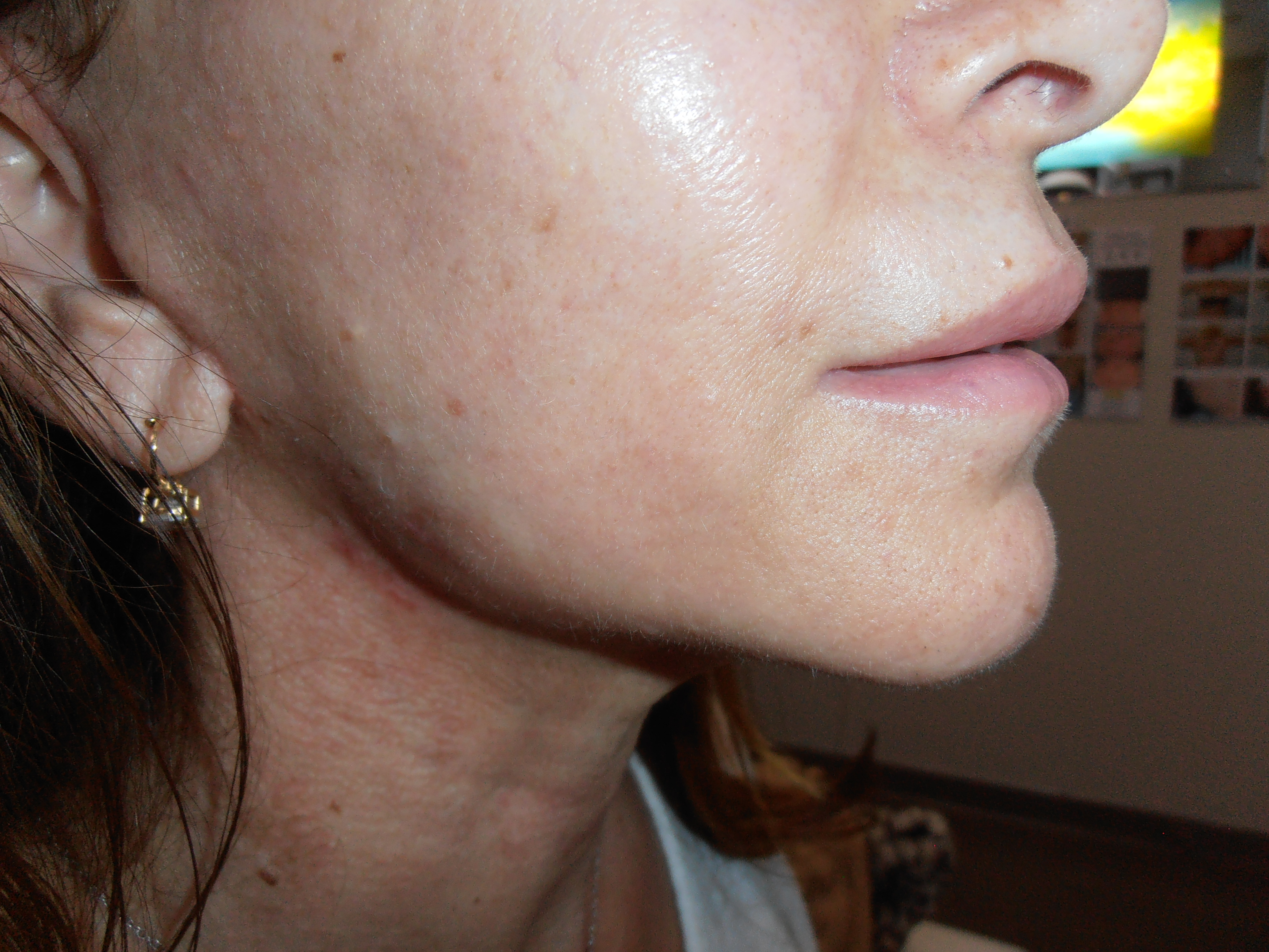 After face and neck lift, patient 5