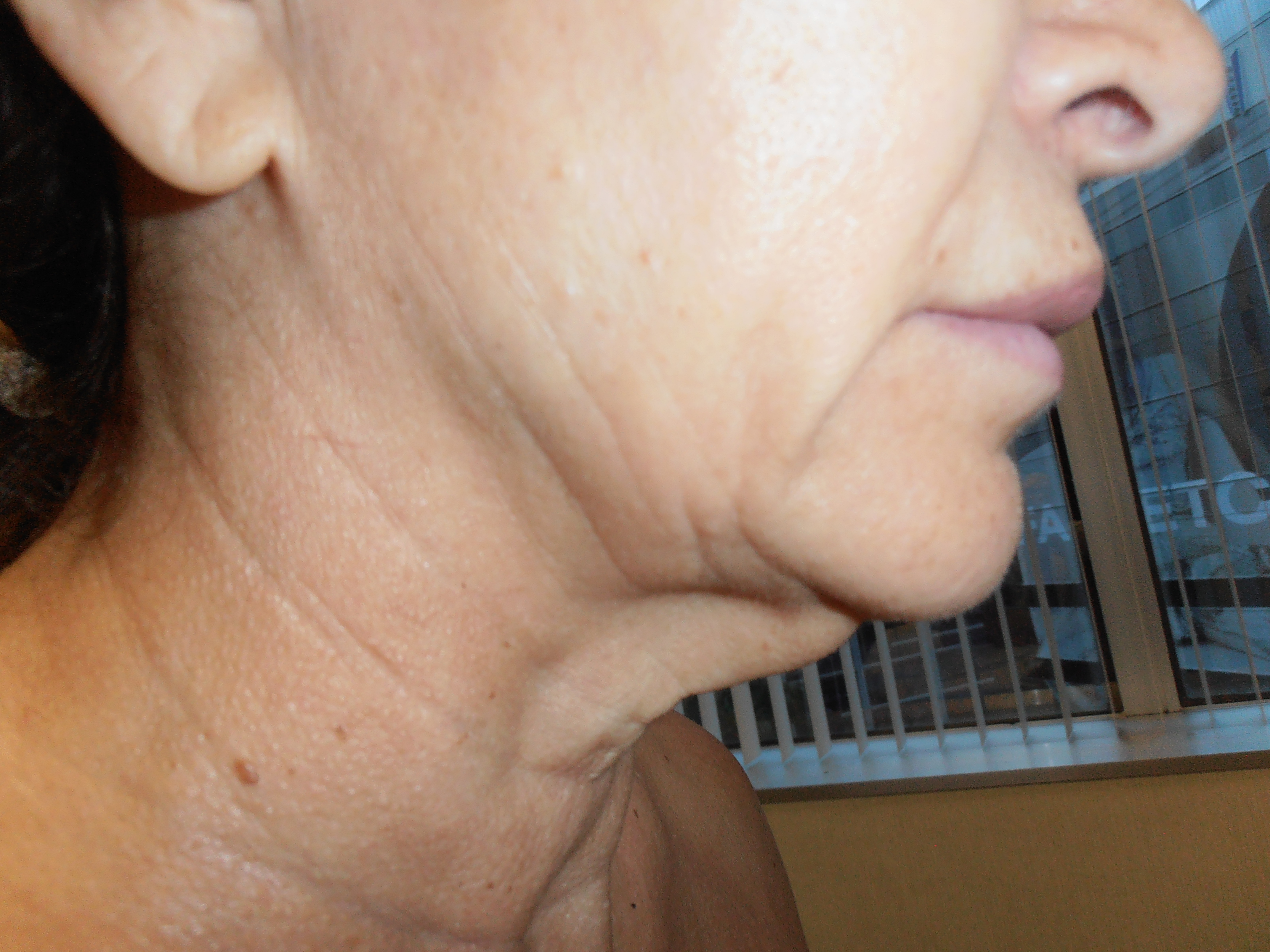 Before face and neck lift, patient 5