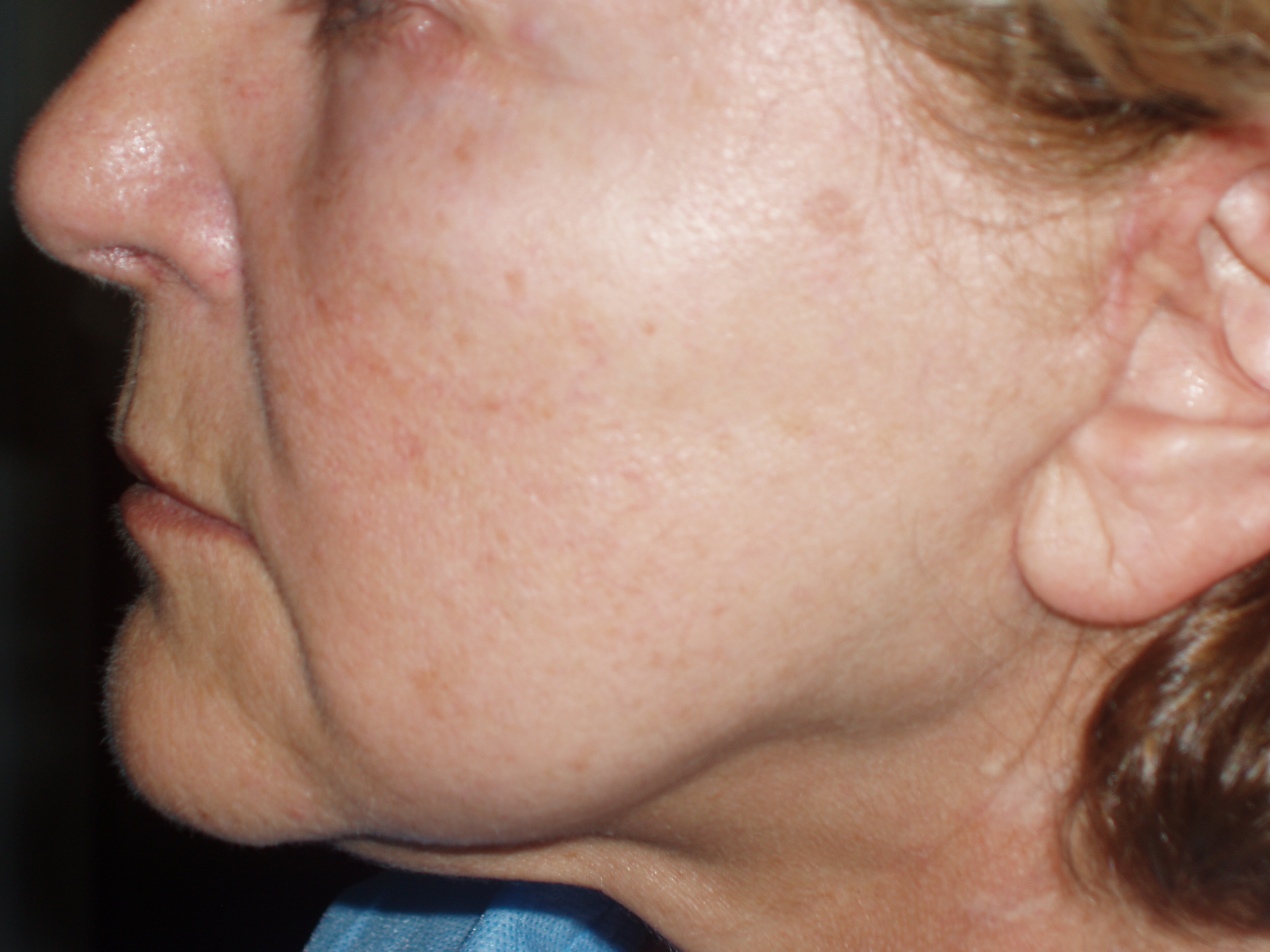 Before face and neck lift, patient 4