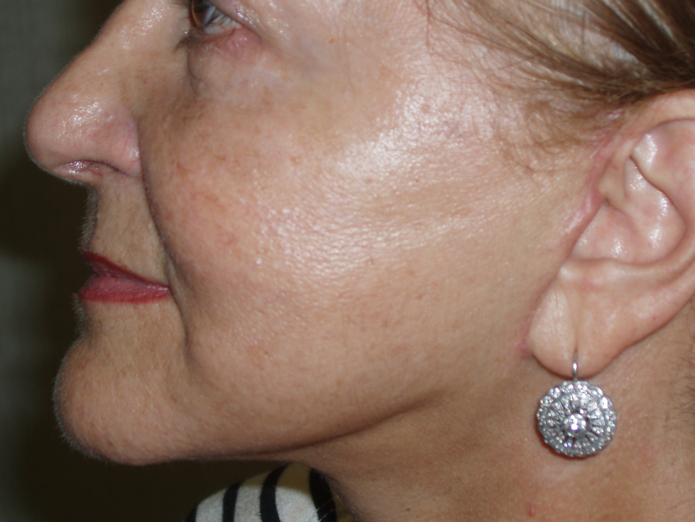 After face and neck lift, patient 4