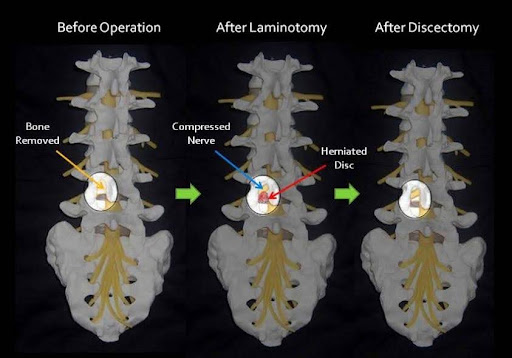 Before and After Microdiscectomy Procedure