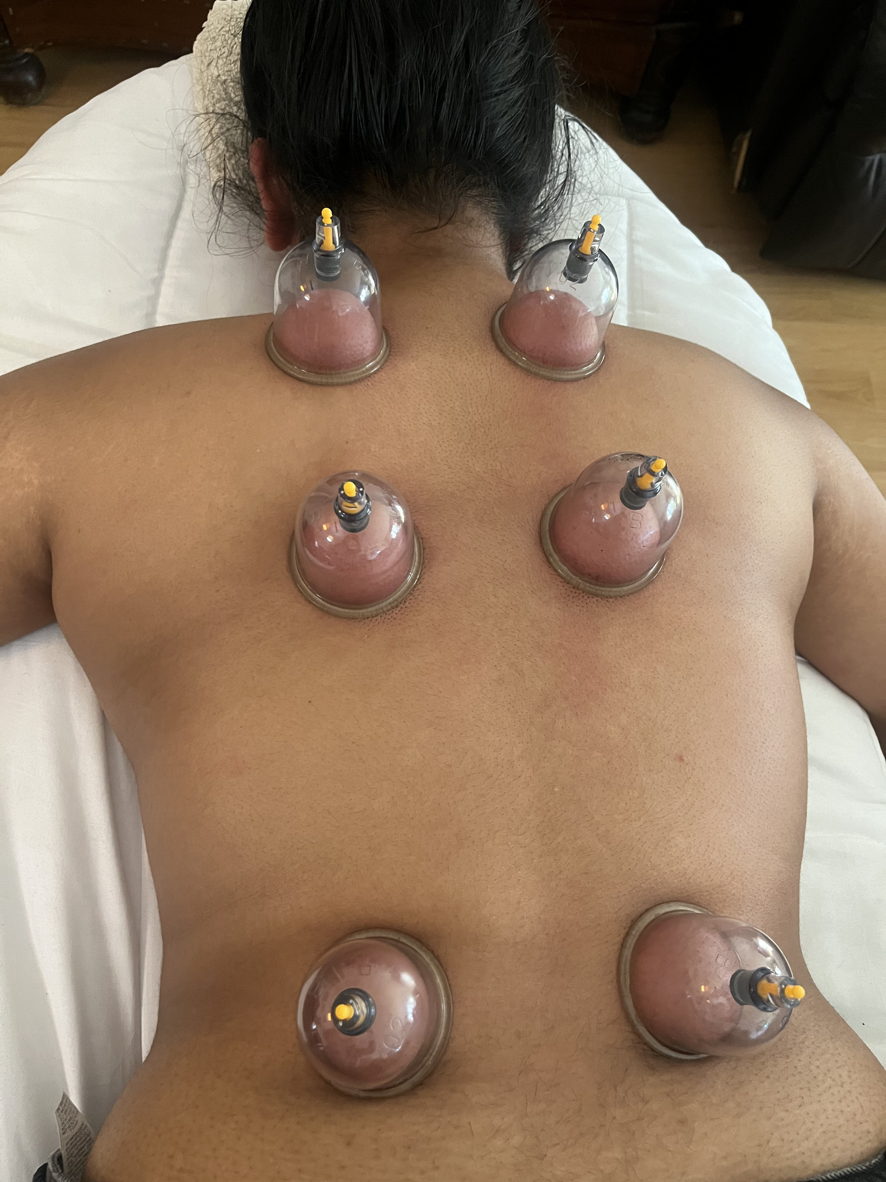 Terapia con ventosas en Barcelona - Montse Tudela