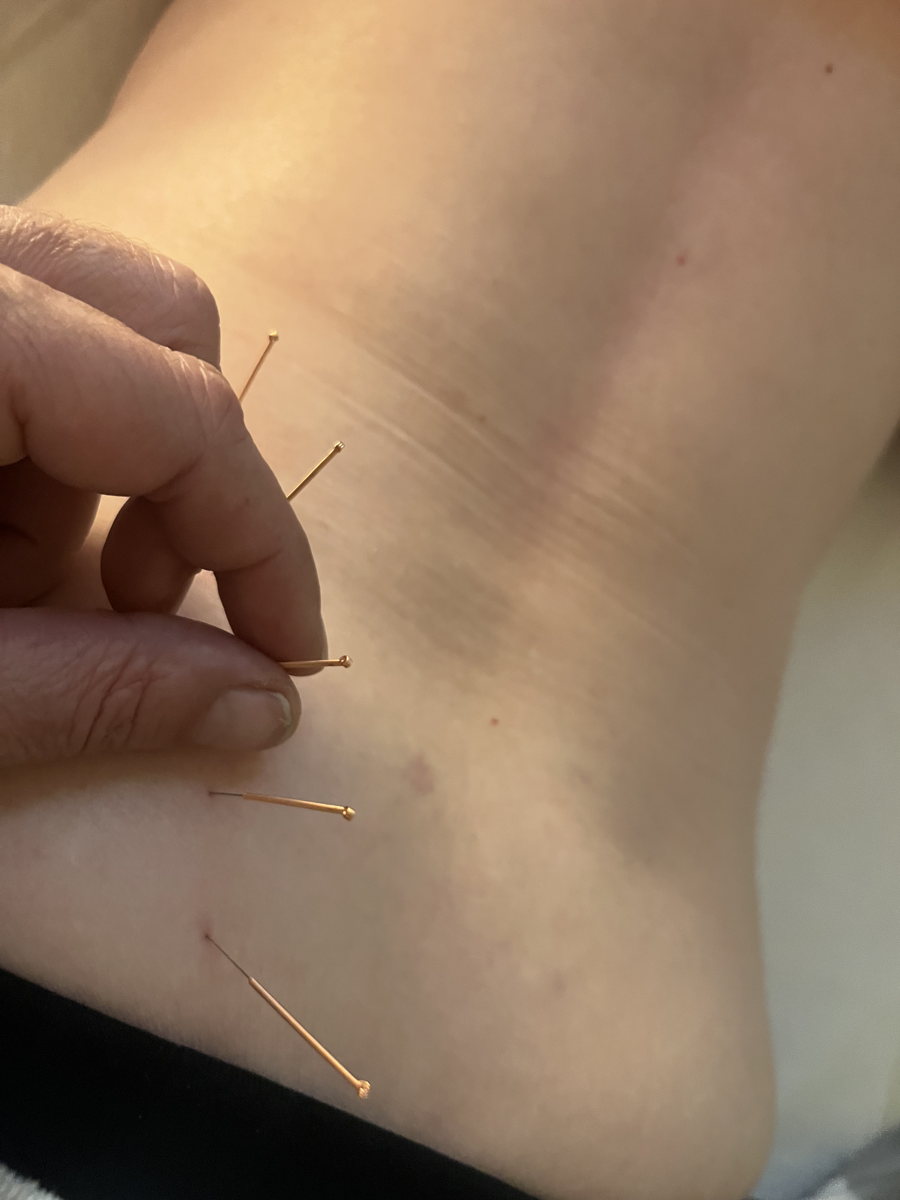 Acupuntura con agujas finísimas - Barcelona