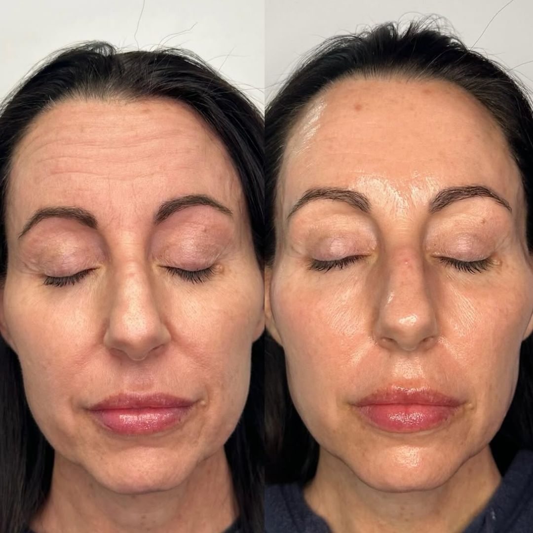 Antes y después del tratamiento