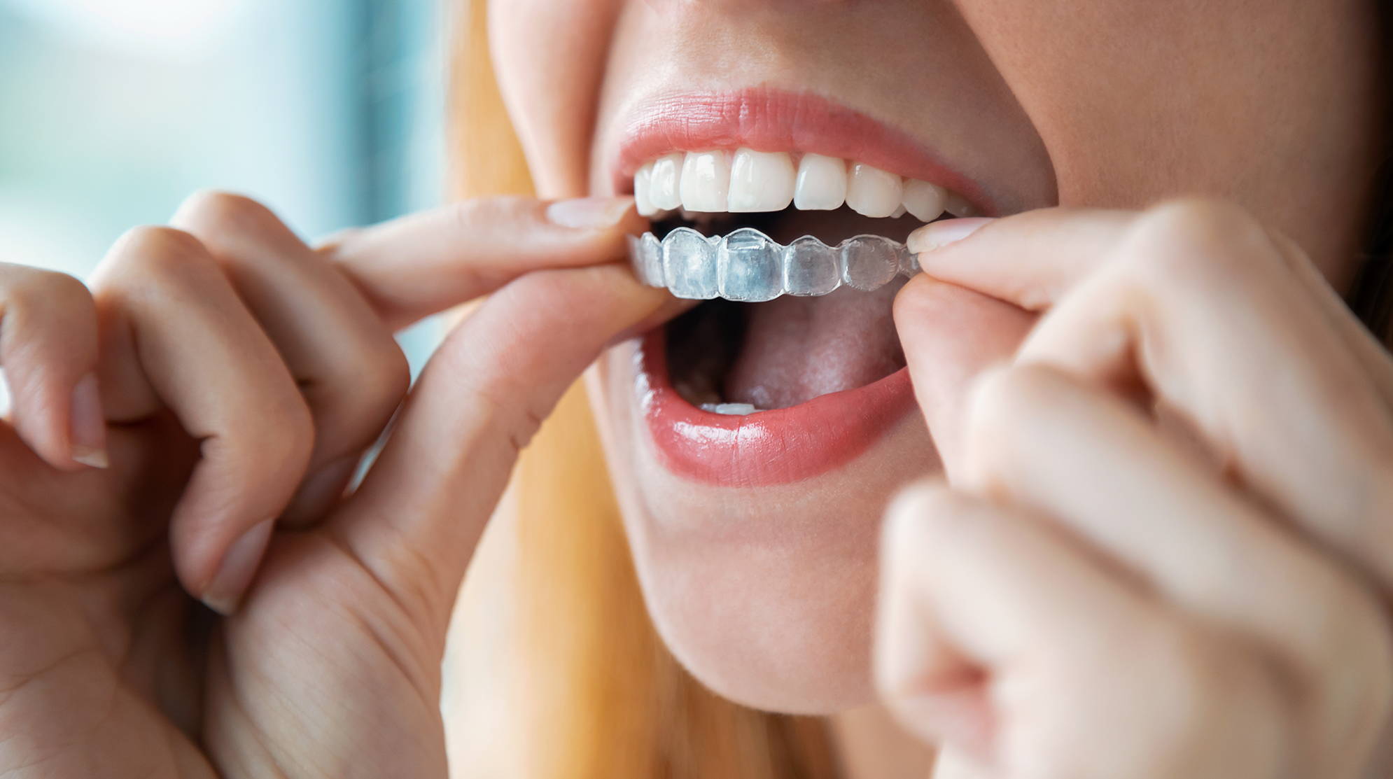 Woman holding invisalign