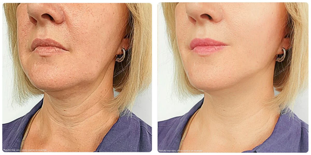 Before and After — Client 1