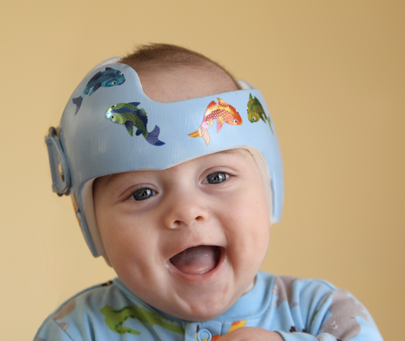 Baby in DOC band (baby helmet) for plagiocephaly