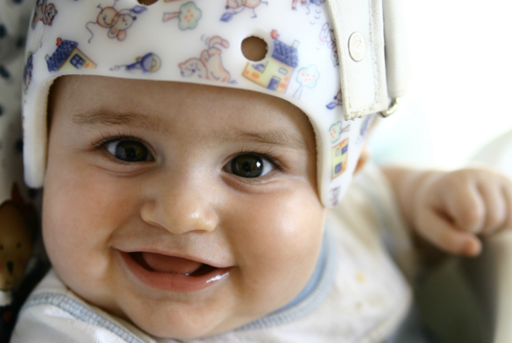 Baby with plagiocephaly wearing a helmet in Scottsdale, AZ