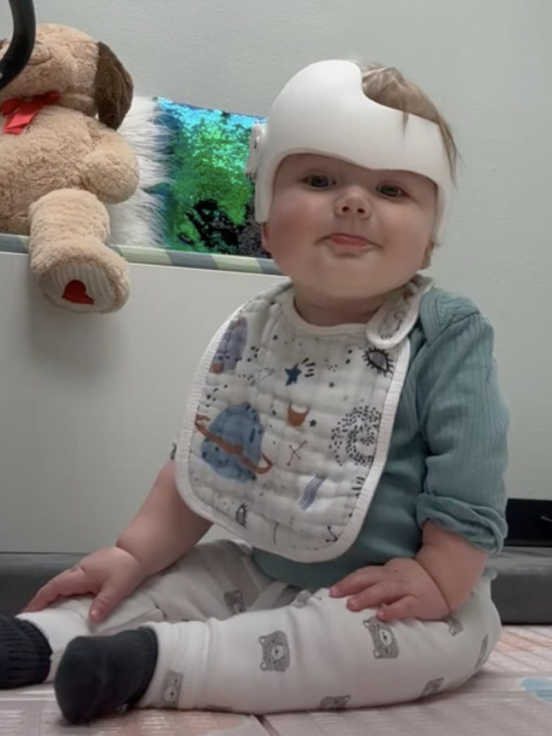 Baby with plagiocephaly wearing DOC band in Scottsdale, AZ