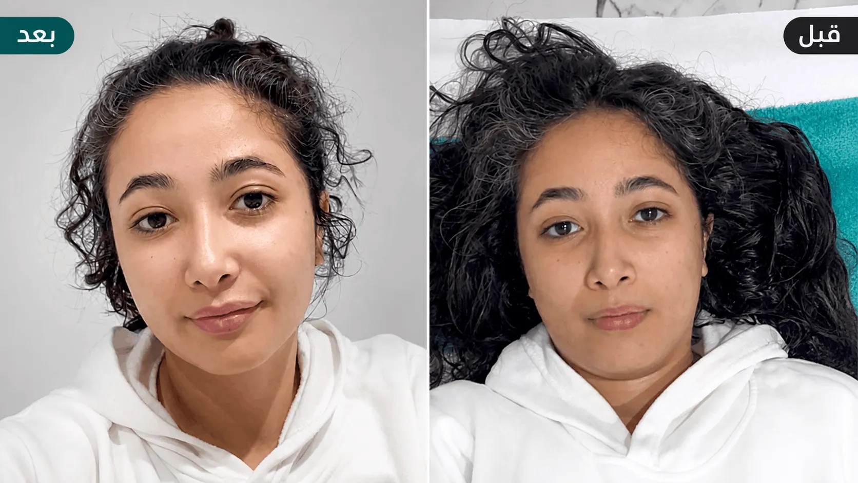 Résultat avant/après de soin chez DOSKIN