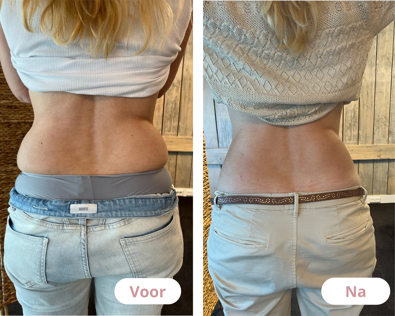 Voor en na cryolipolyse behandeling