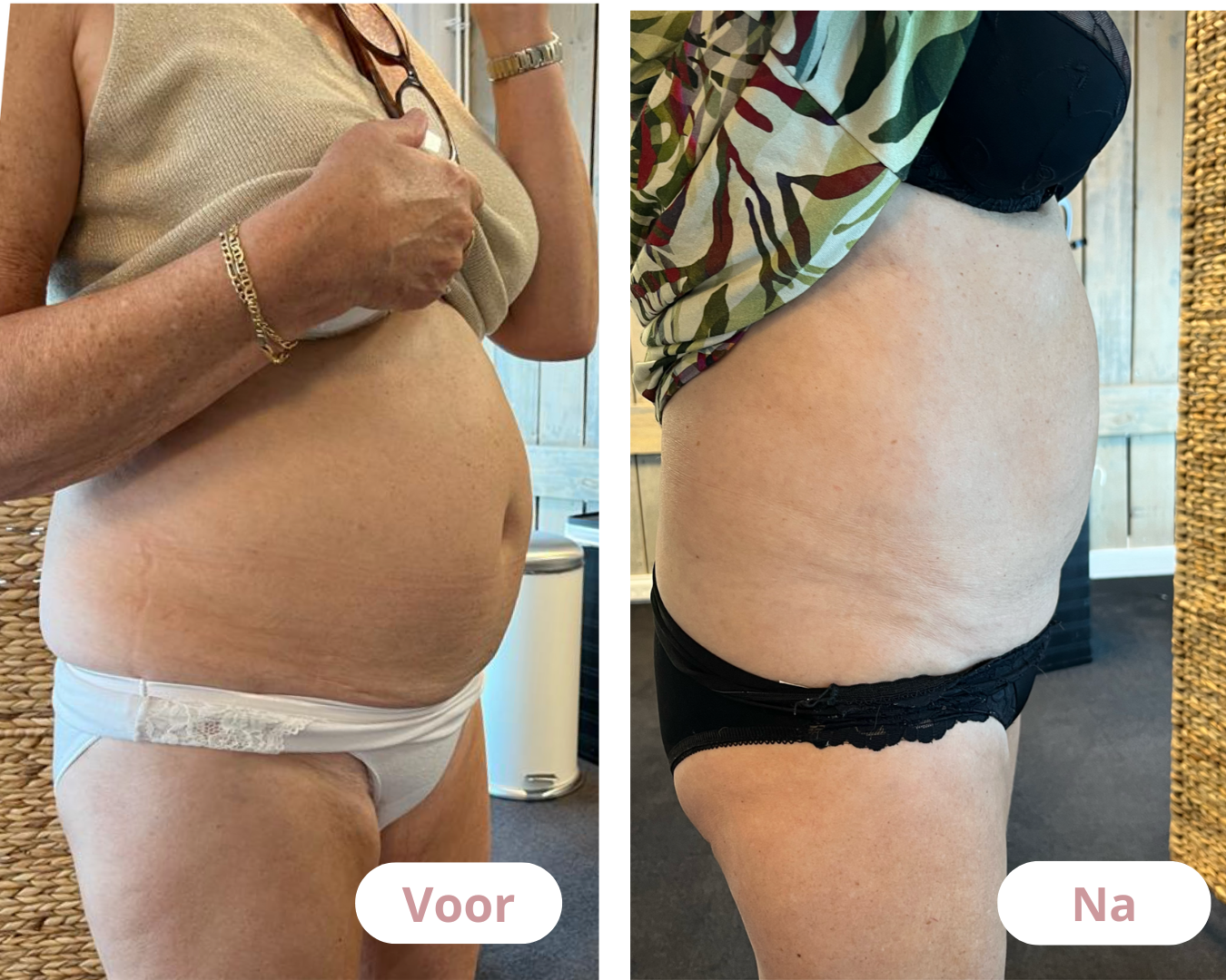 Voor en na resultaat buik en taille
