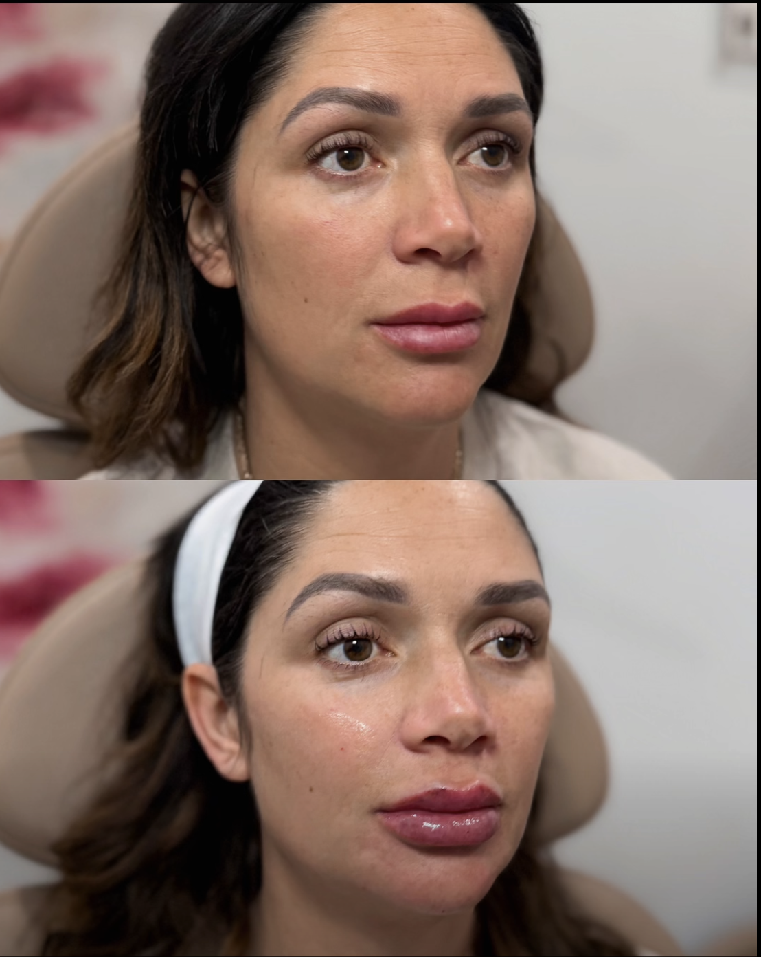 Before and after medical spa injectable results with natural lip enhancement and facial balancing, supporting a blog about AI in aesthetics, facial anatomy, and why expert injectors matter. Before and after medical spa injectable results with natural lip enhancement and facial balancing, supporting a blog about AI in aesthetics, facial anatomy, and why expert injectors matter.