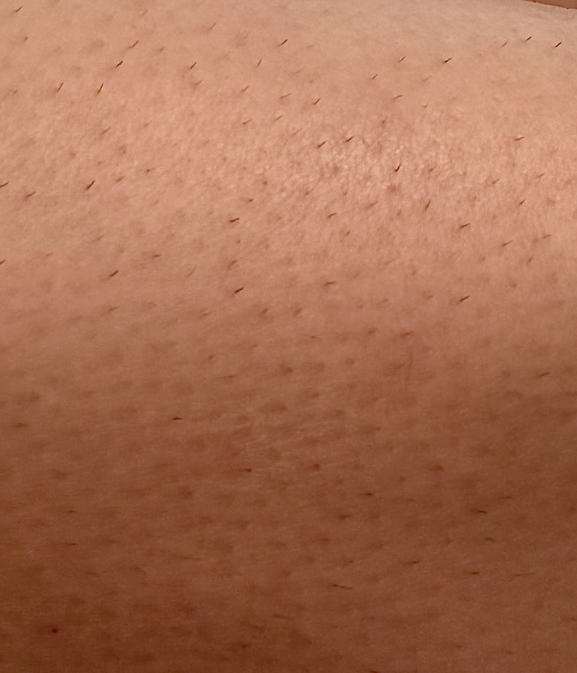 Pokožka pred laserovou epiláciou