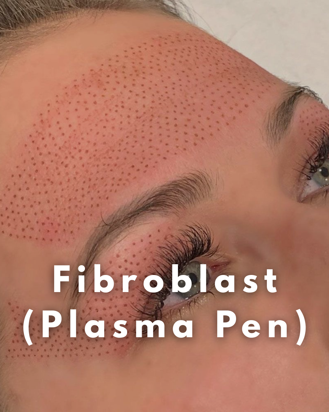 Fibroblast
