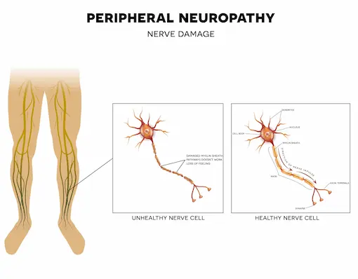 Burning feet at night neuropathy evaluation Vacaville