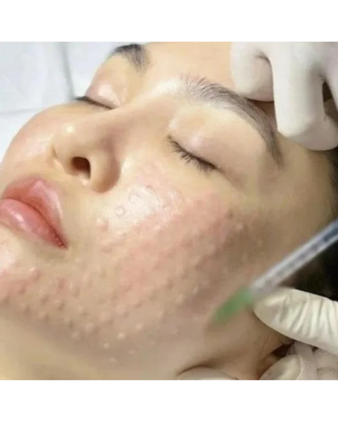 Skinbooster / Exossomos