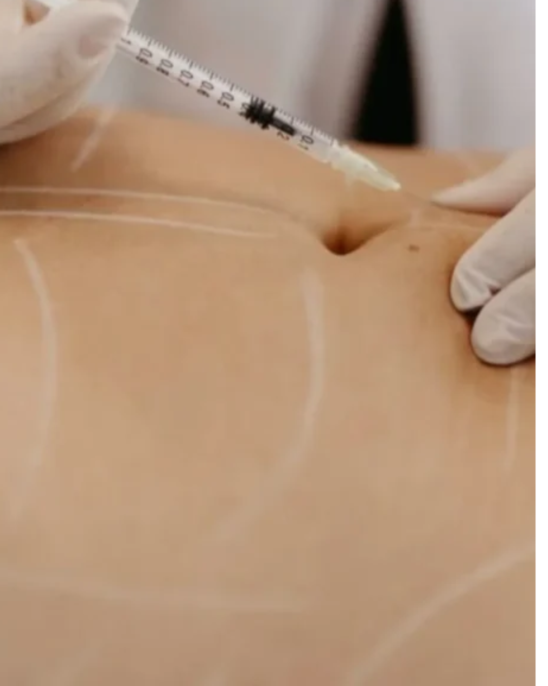 Lipo Enzimatica Por Regiao Radiofrequencia