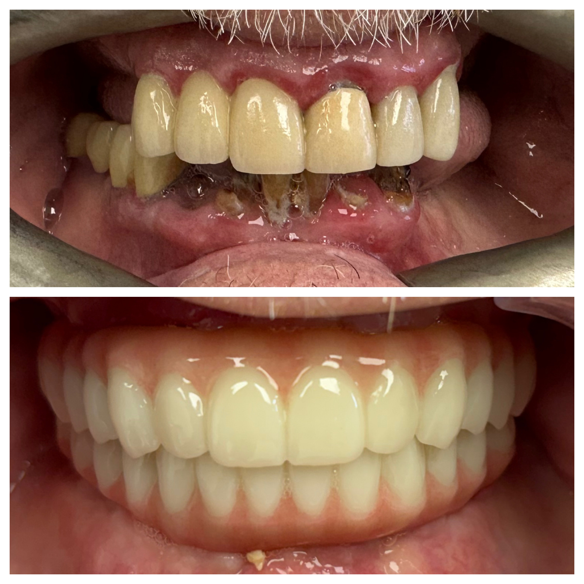 dental implants before and after fair lawn nj