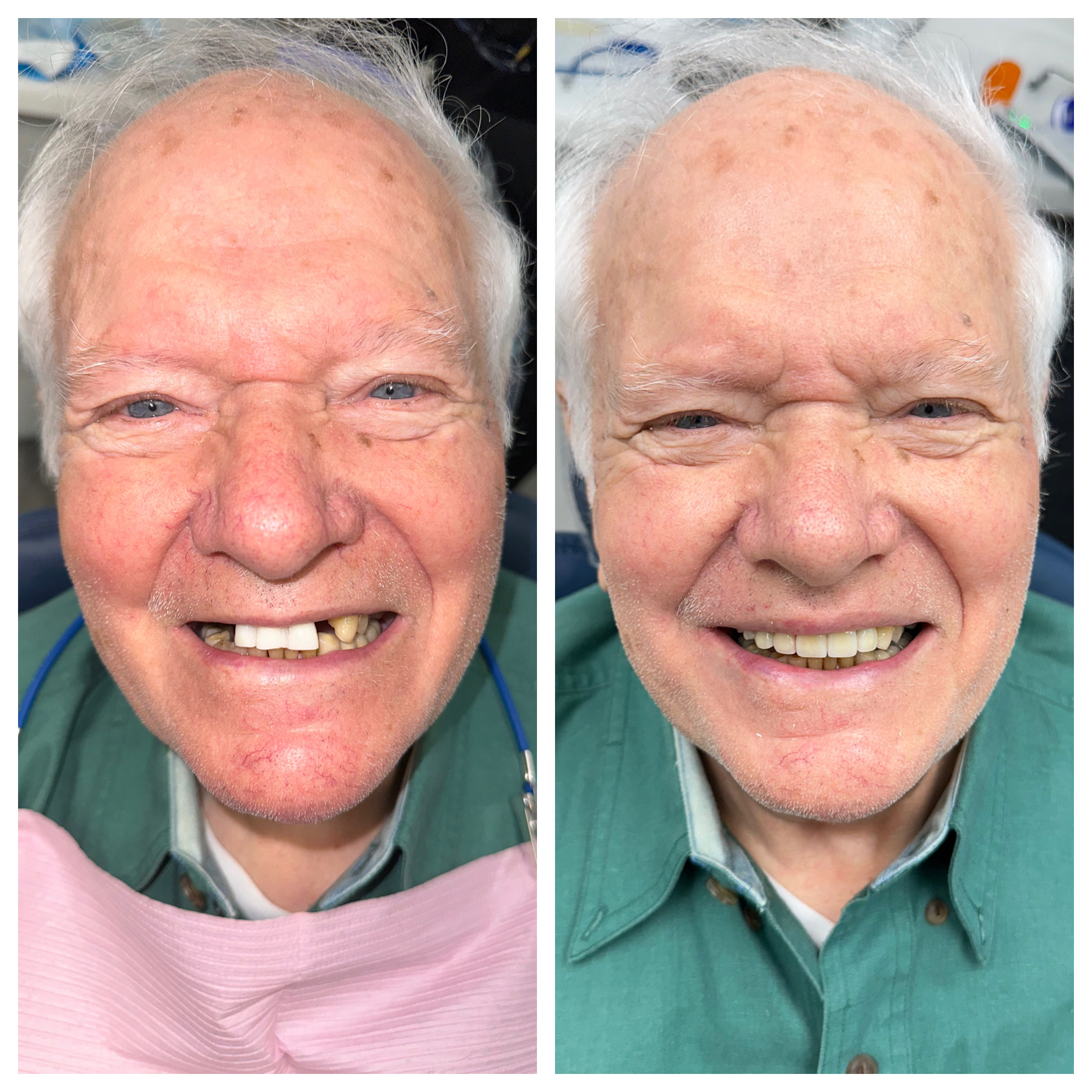 dental implant smile transformation fair lawn nj