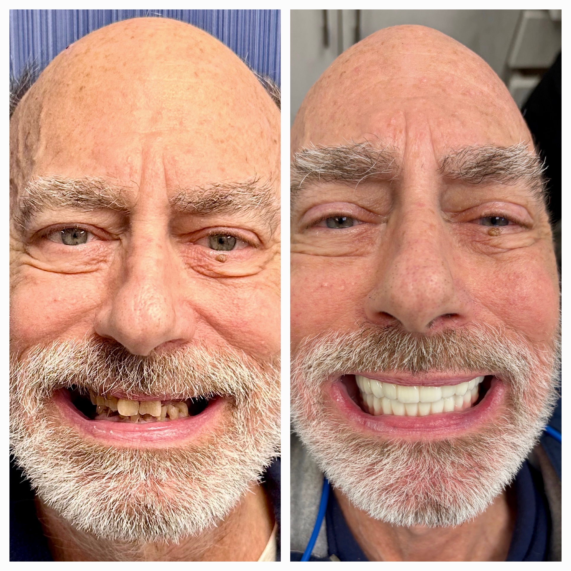 dental implant smile transformation fair lawn nj